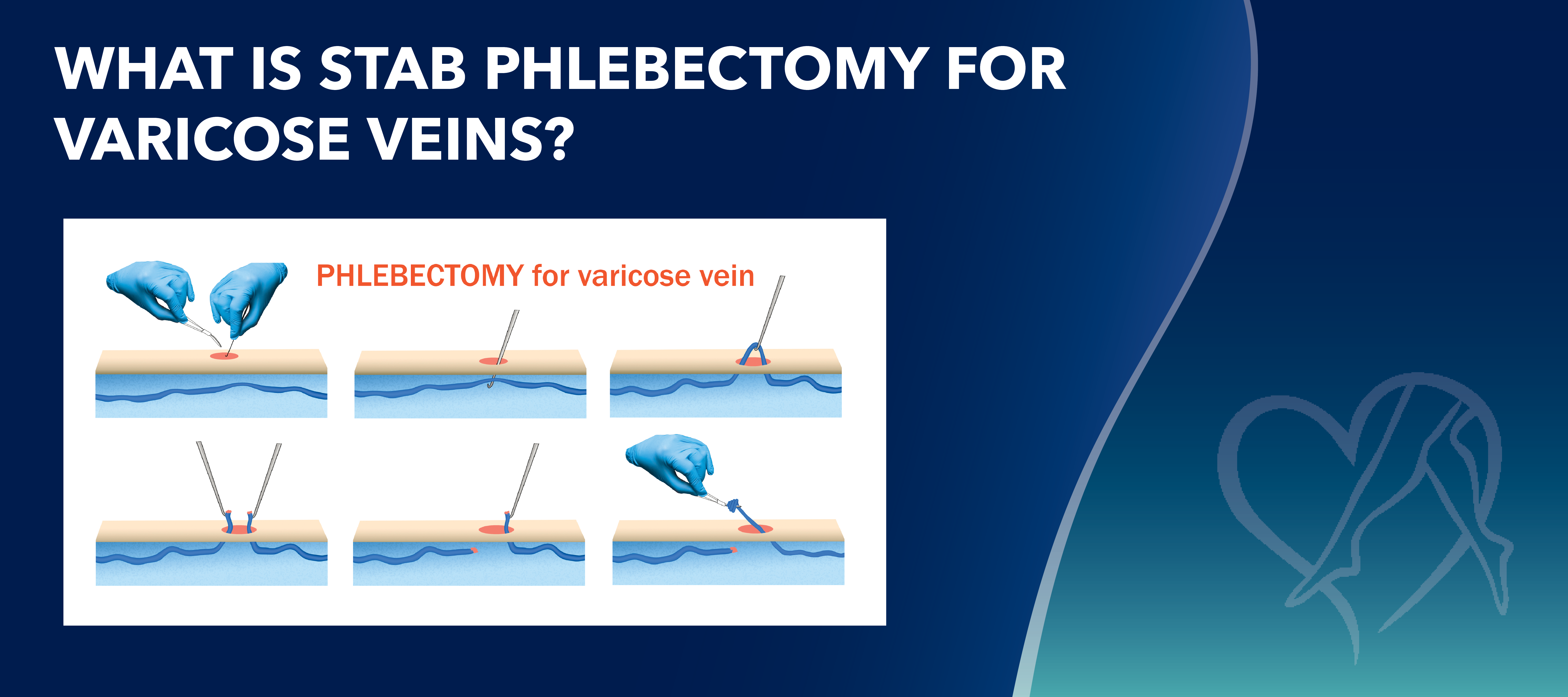 Blog Image Whatis Stab Phlebectomyfor Varicose Veins