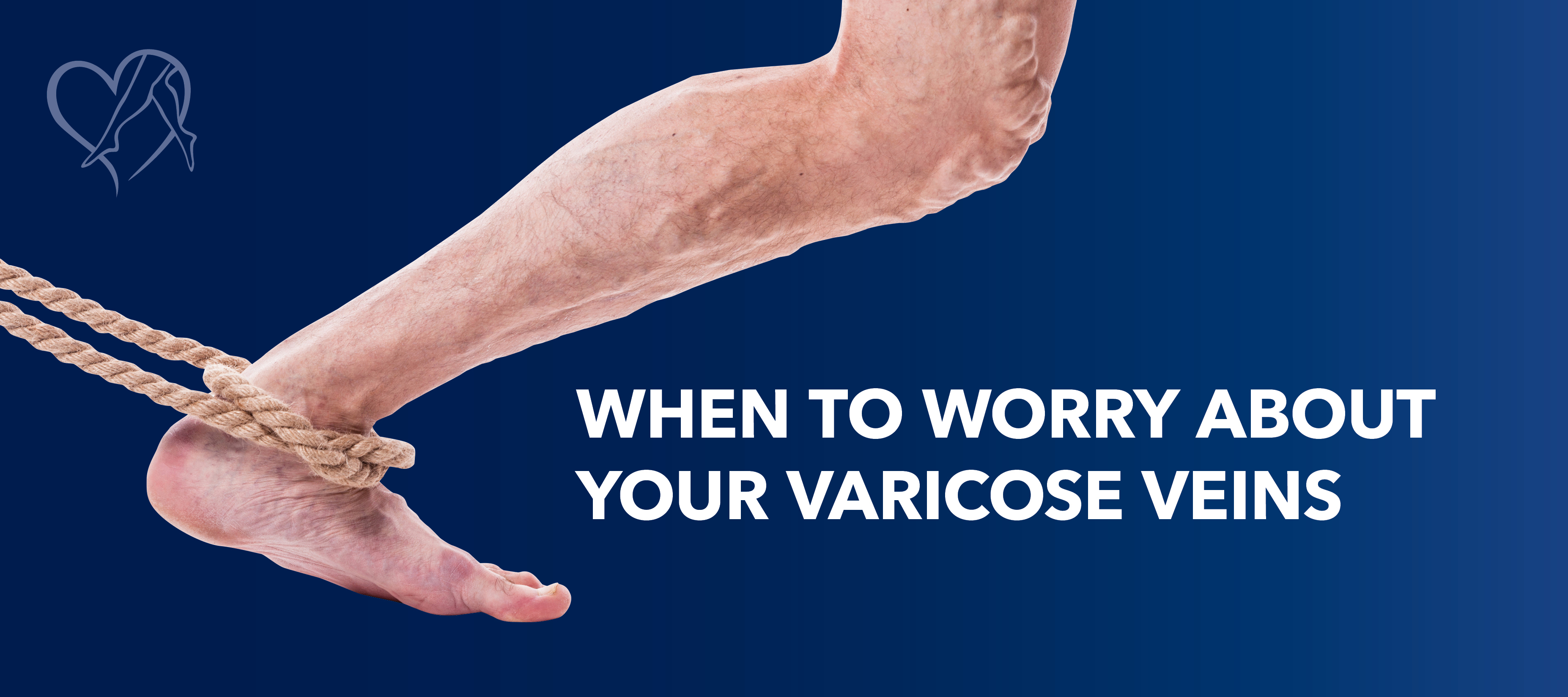 Blog Image When To Worry About Varicose Veins