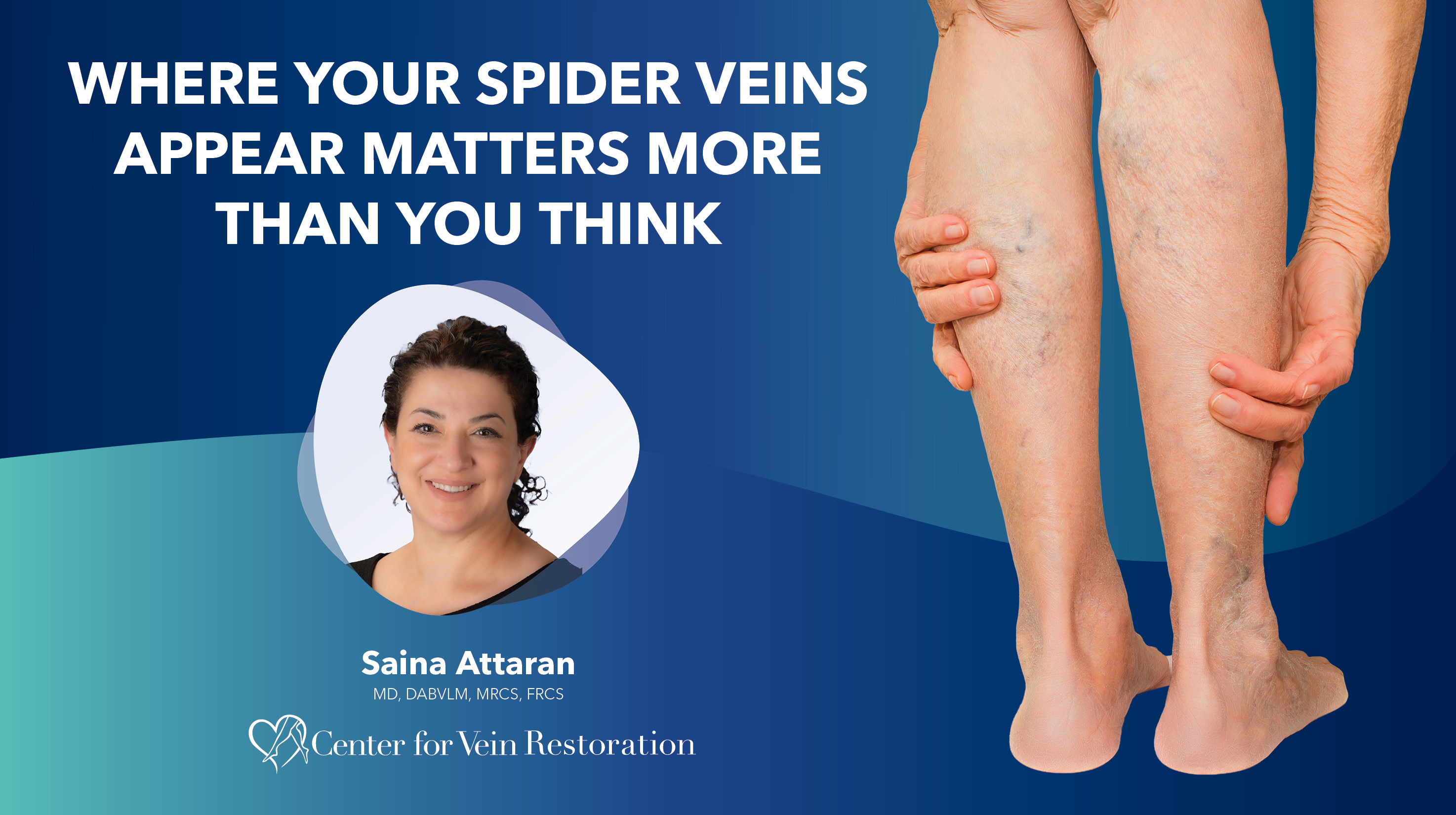 Blog Image Where Your Spider Veins Appear Matters More Than You Think