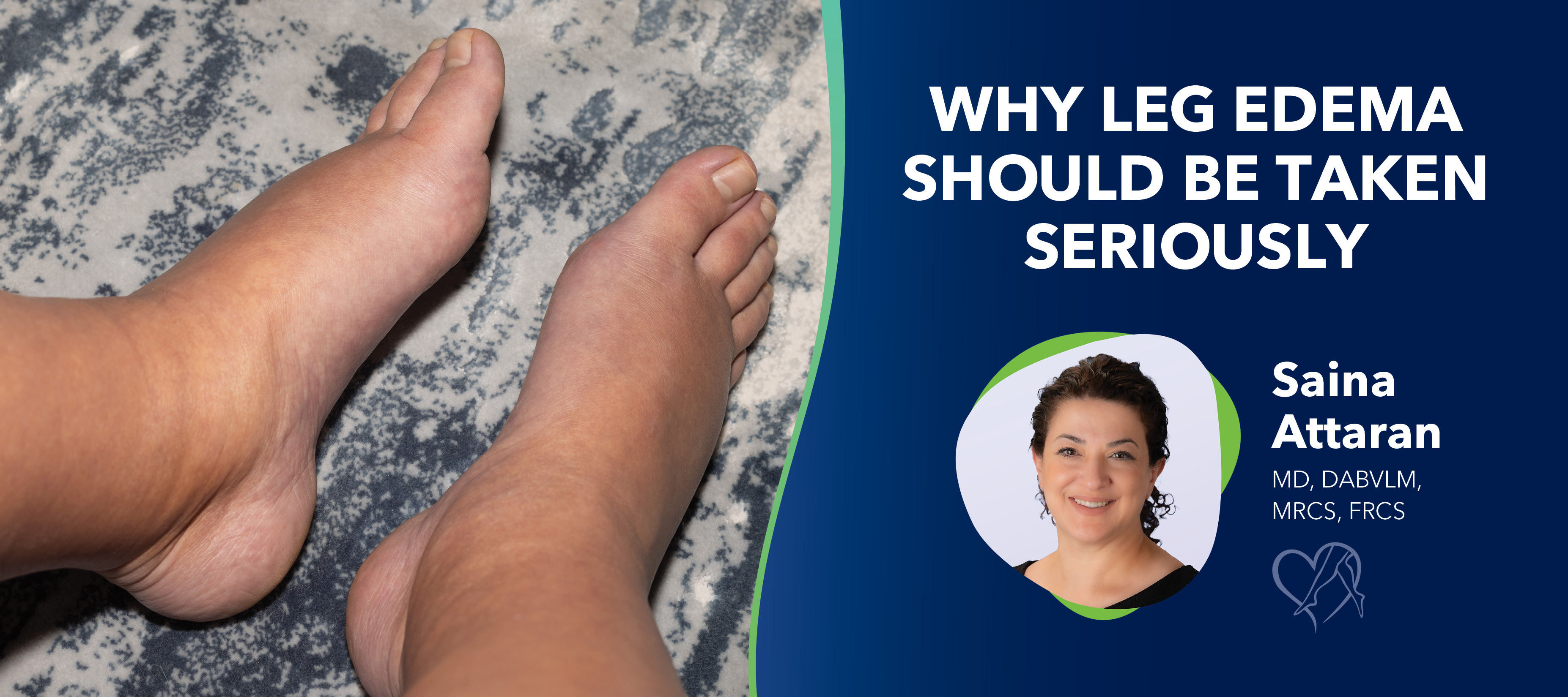 Blog Image Why Leg Edema Should Be Taken Seriously