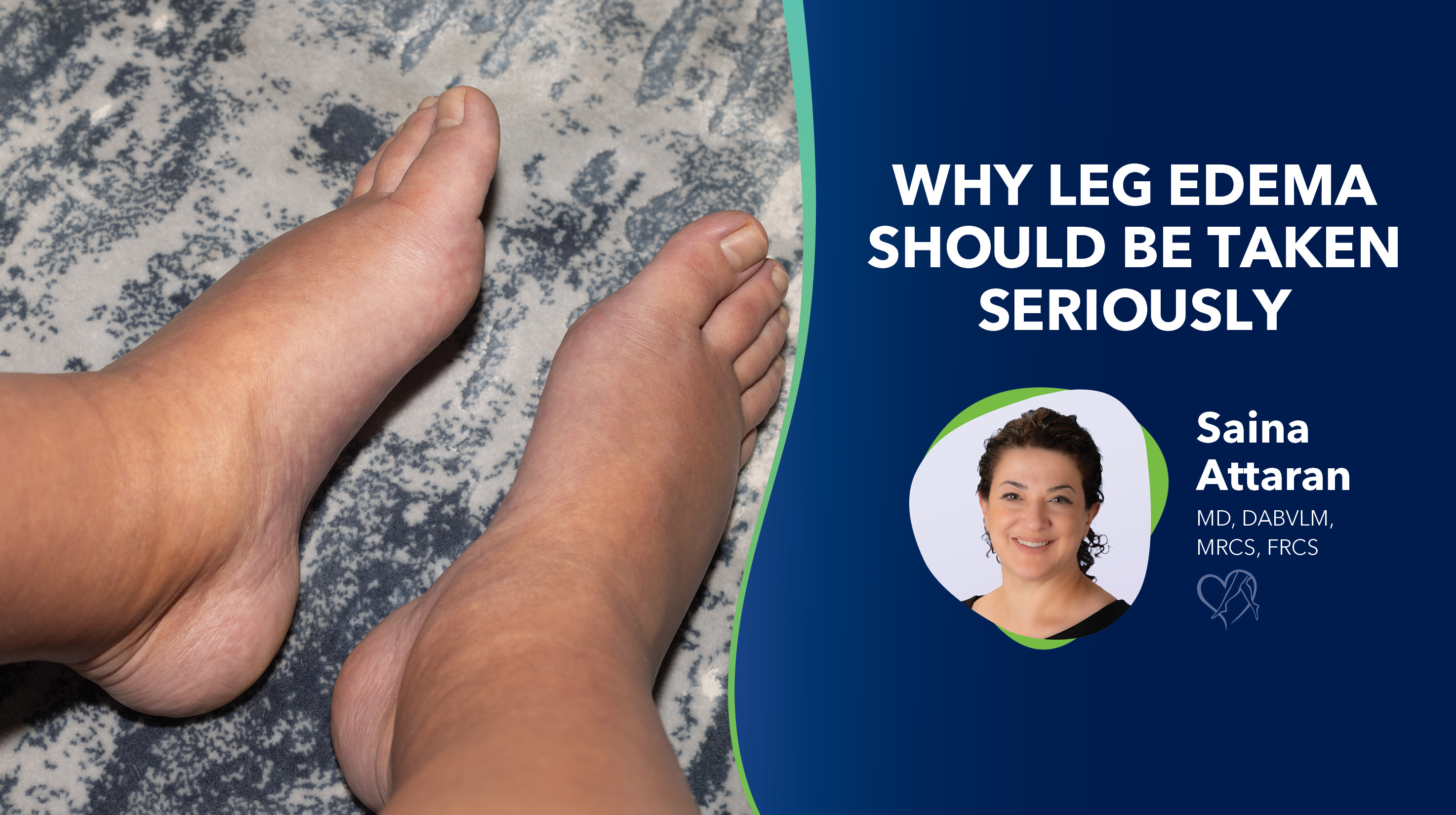 Blog Image Why Leg Edema Should Be Taken Seriously Thumbnail