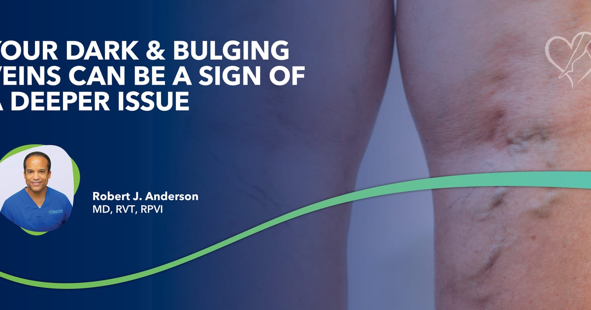 Your Dark & Bulging Veins Can Be a Sign of a Deeper Issue