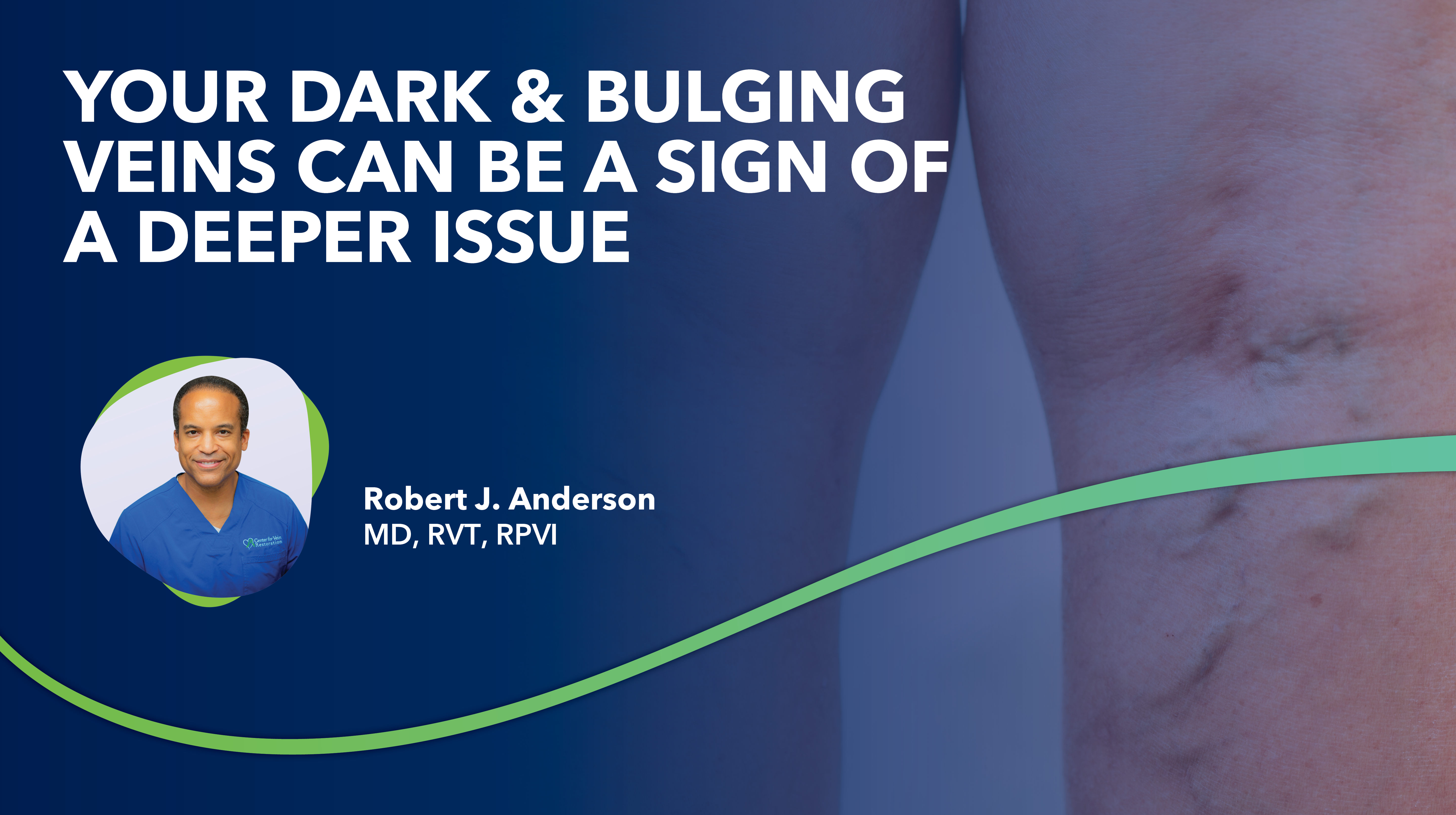 Blog Image Your Dark Bulging Veins Can Be a Sign of a Deeper Issue thumbnail