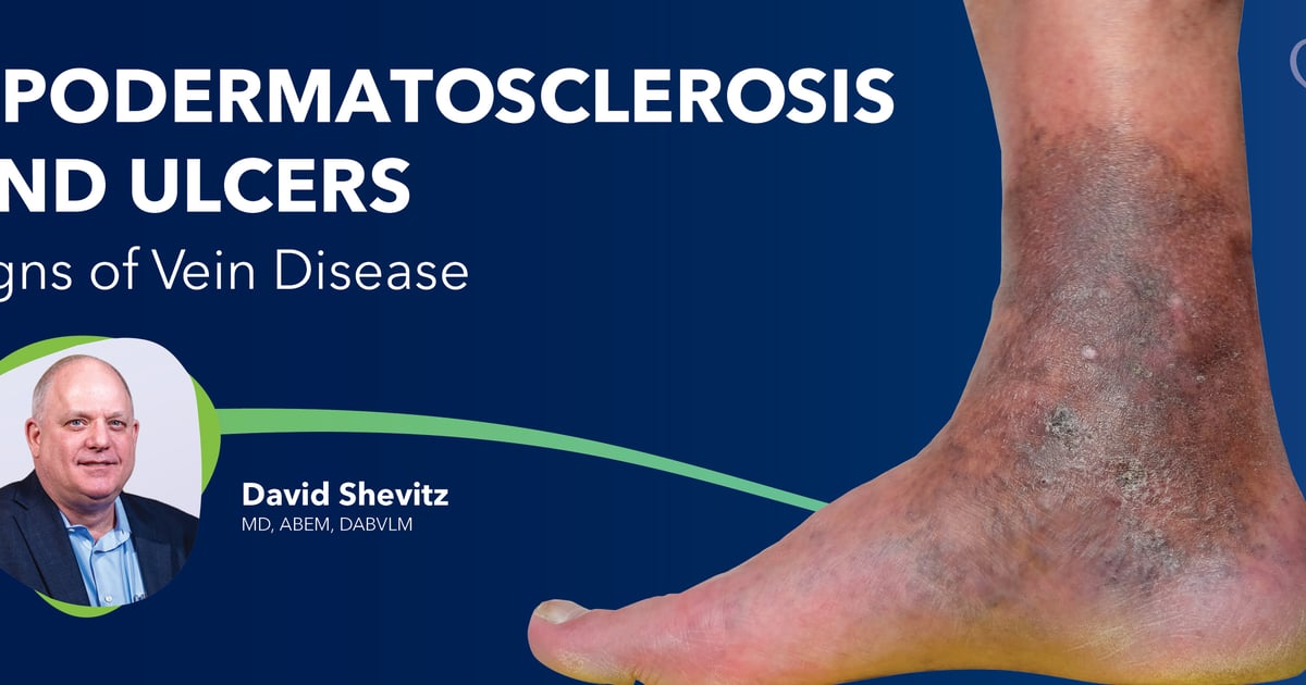 Lypodermatosclerosis Lipodermatosclerosis and Ulcers: Signs of Vein Disease