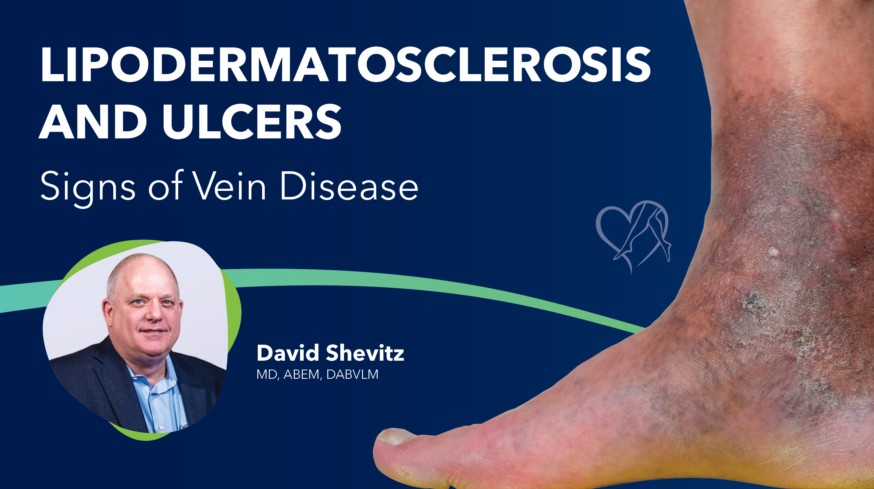 Blog Image lipodermatosclerosis and Ulcers Thumbnail