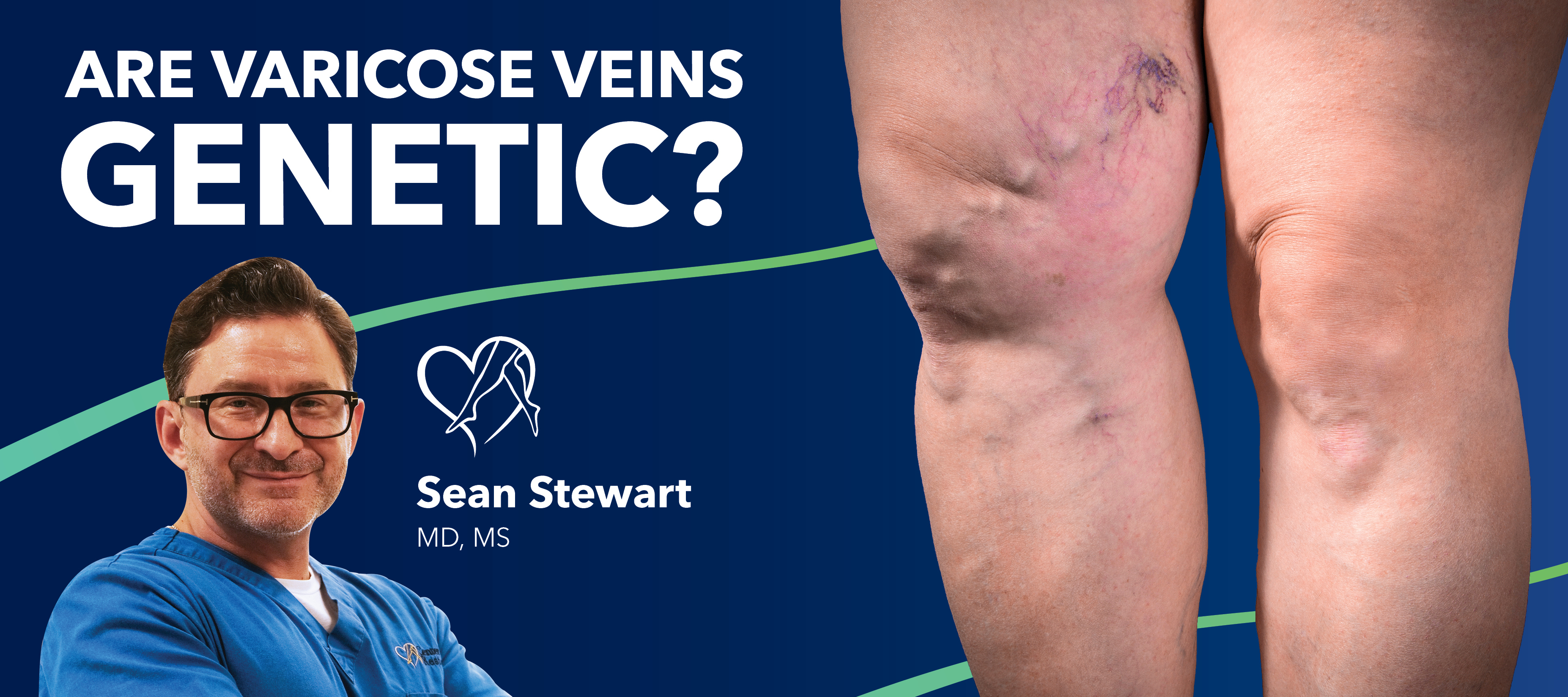 Blog Are Varicose Veins Genetic