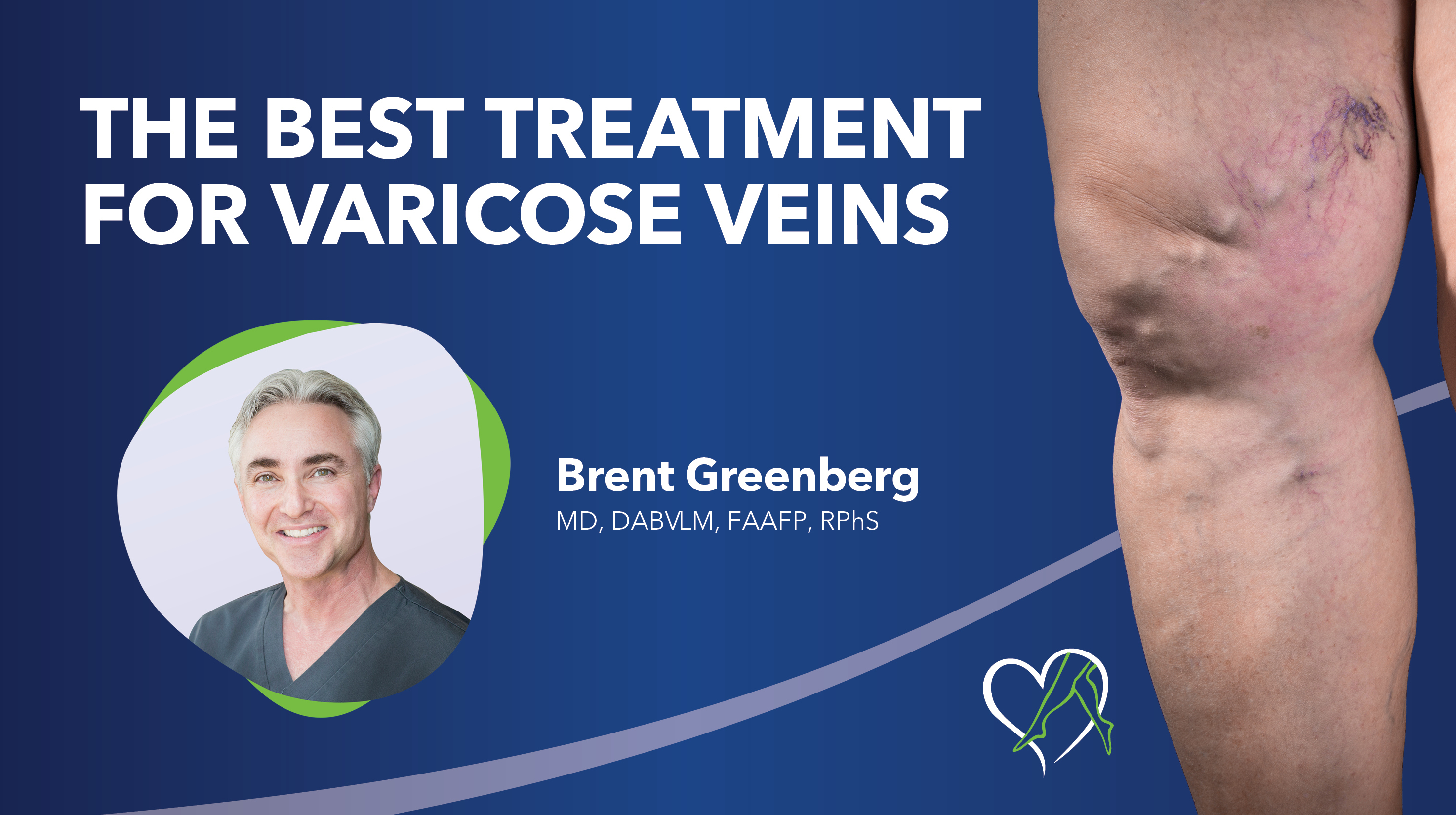 Blog Best Treatmentfor Varicose Veins Thumbnail