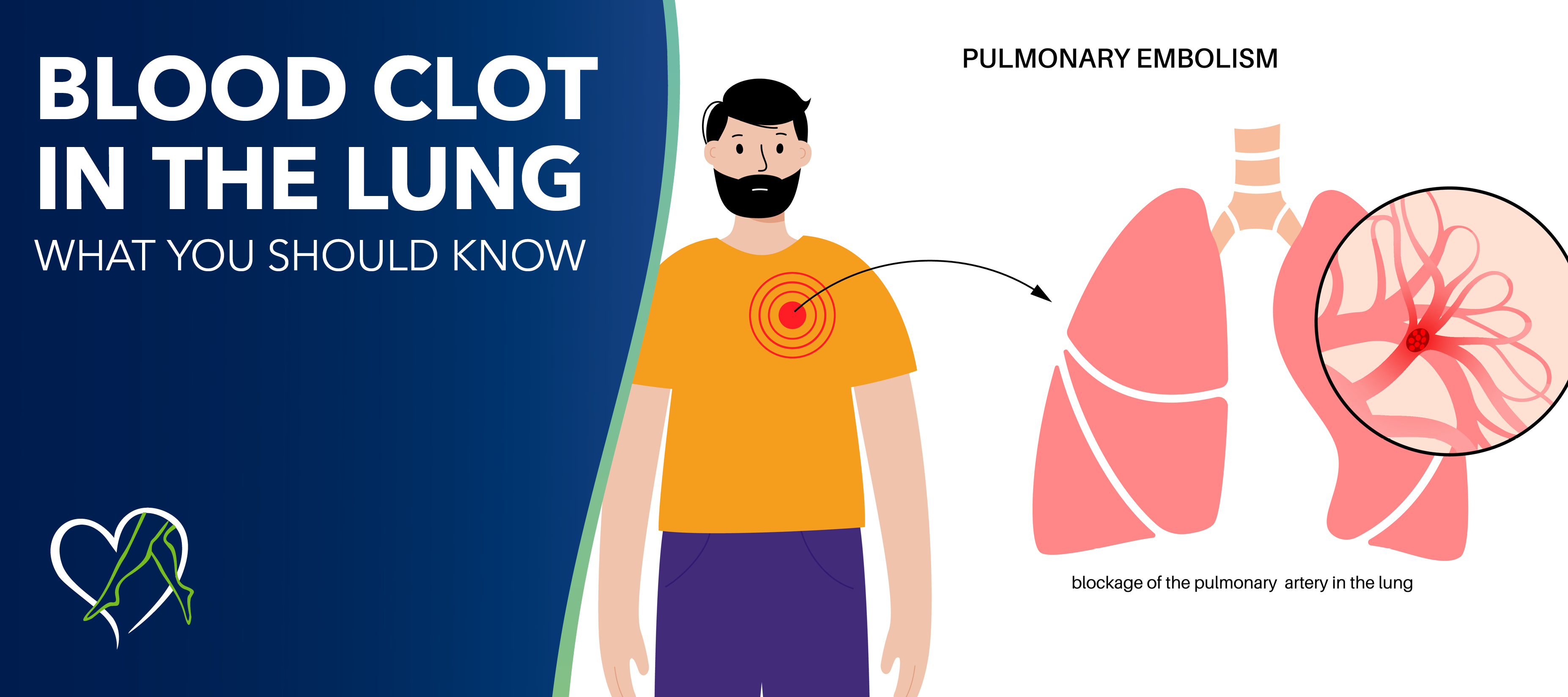 Blog Blood Clot In The Lung