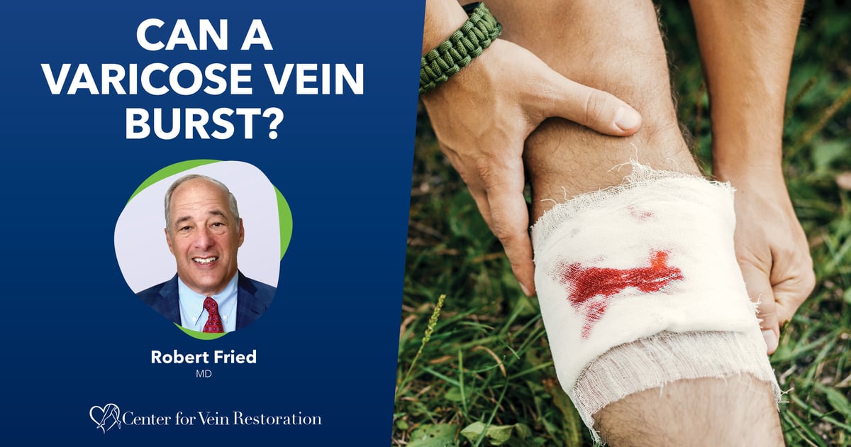 Vein Explodes Can a Varicose Vein Burst?