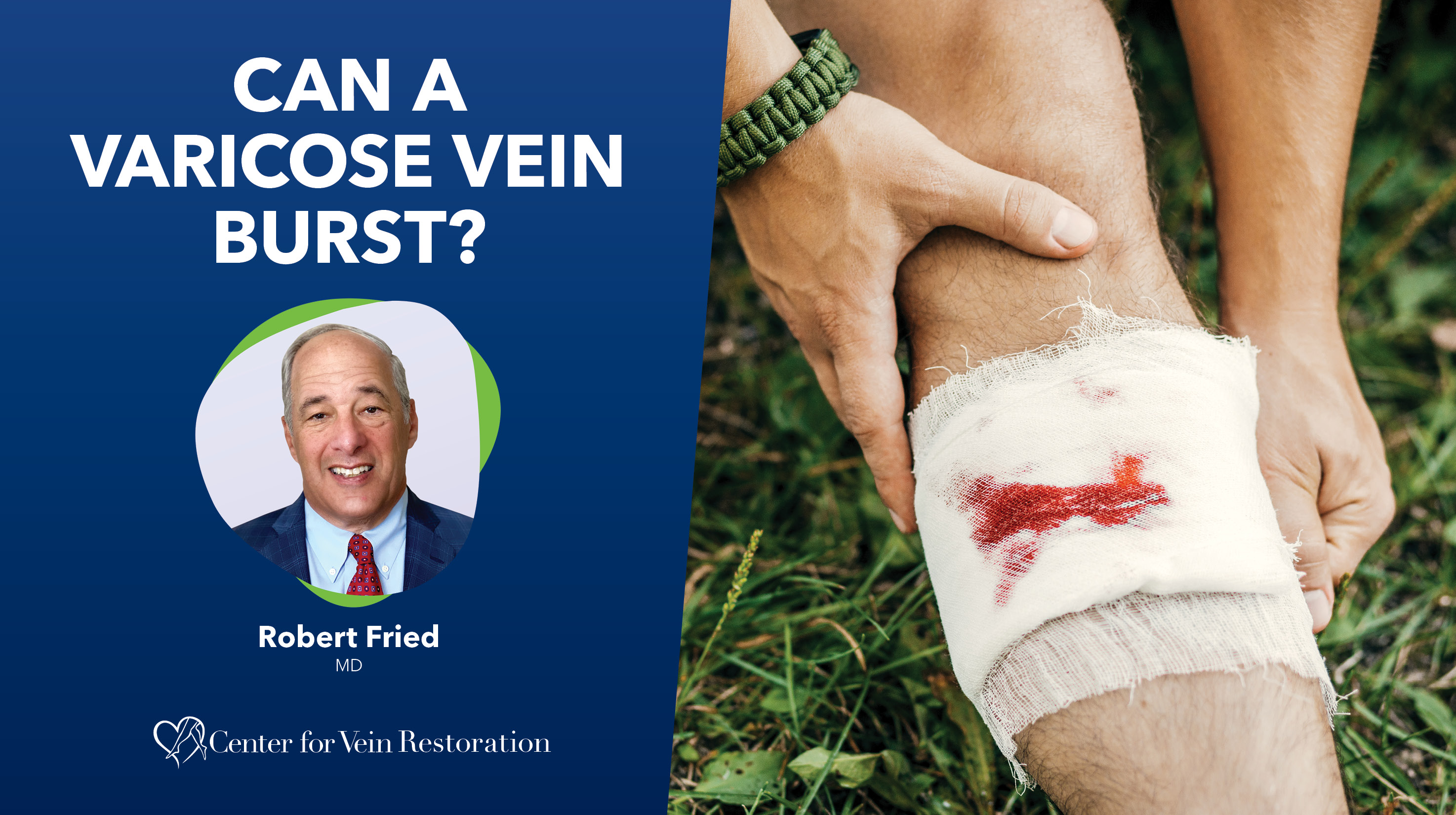 Can a Varicose Vein Burst?