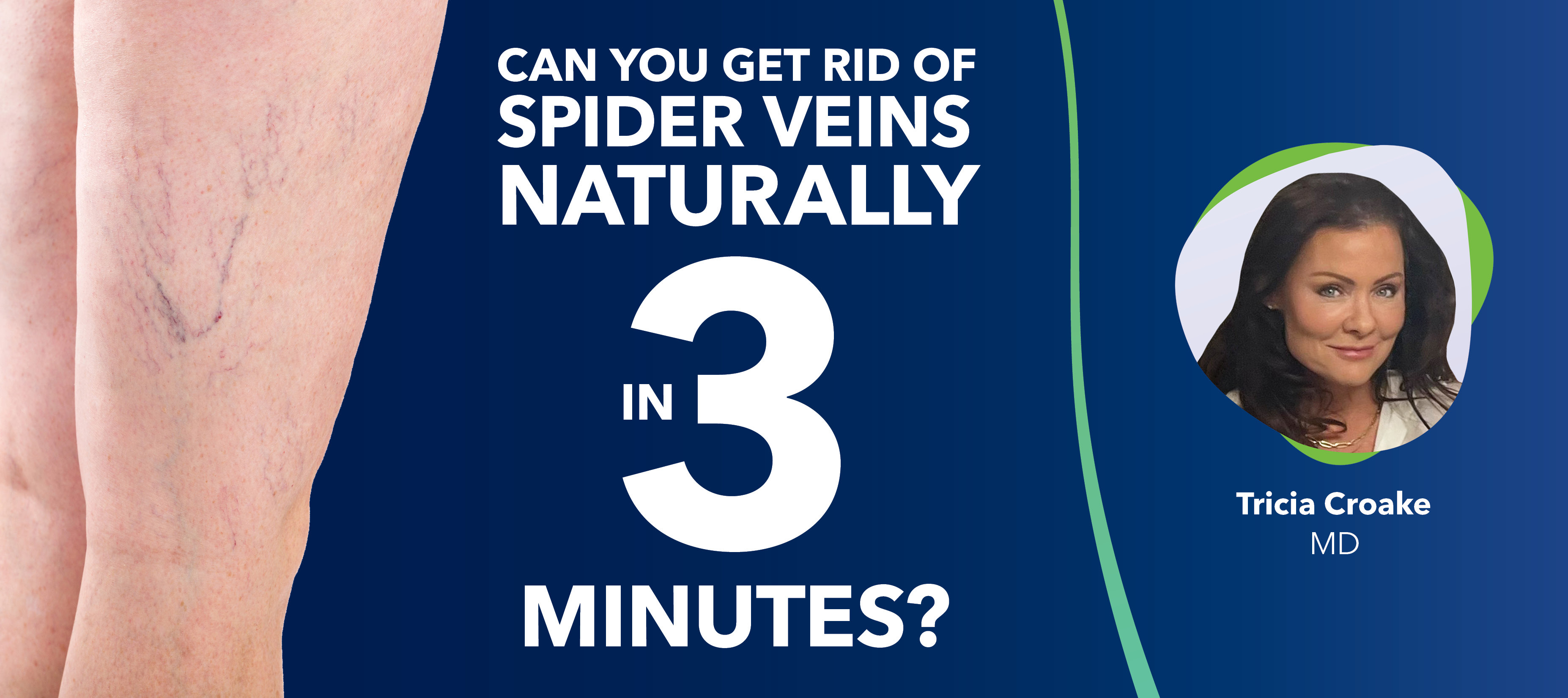 Can You Get Rid of Spider Veins Naturally in Three Minutes?