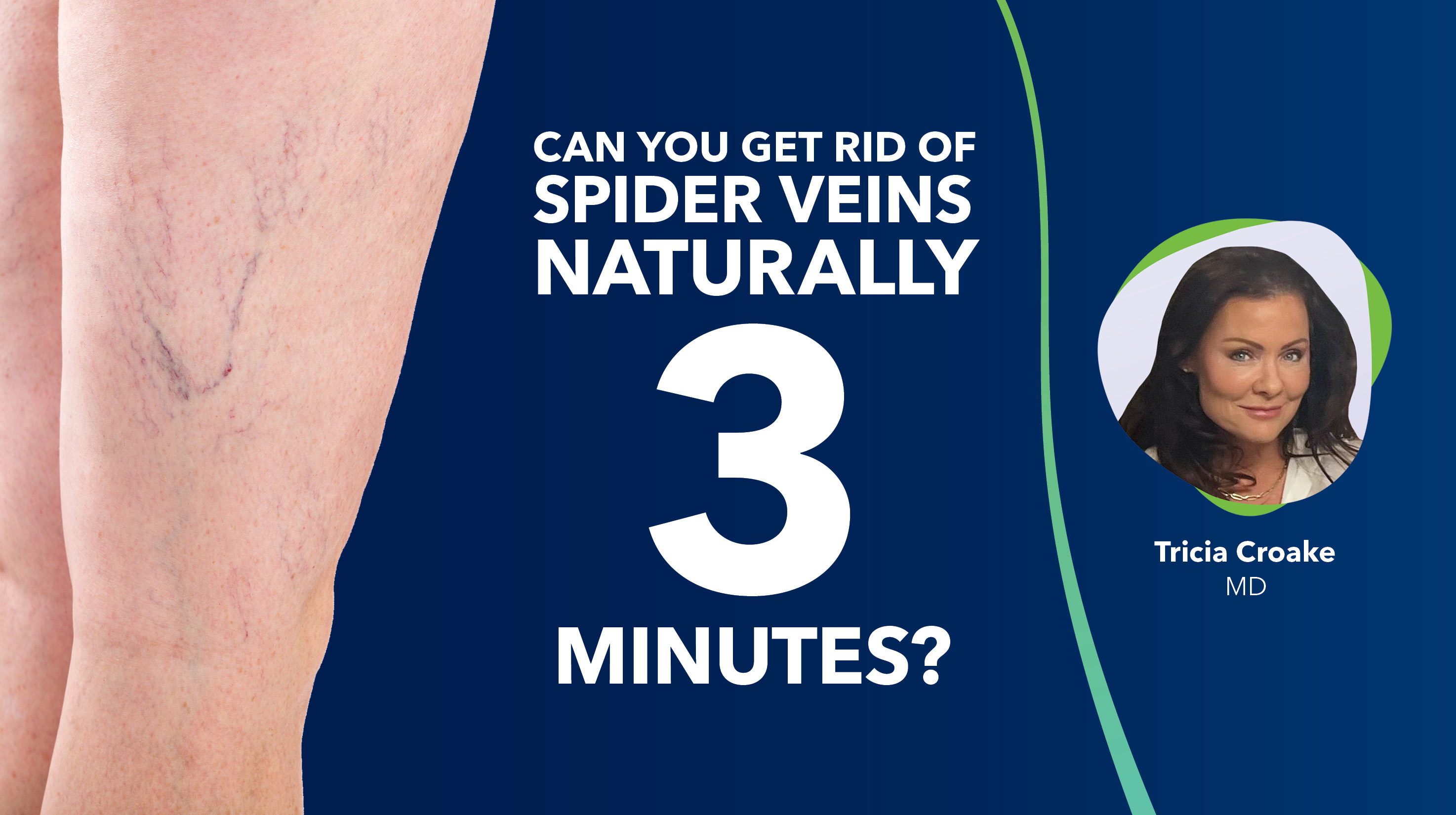 Blog Can You Get Ridof Spider Veins Naturallyin Three Minutes Thumbnail