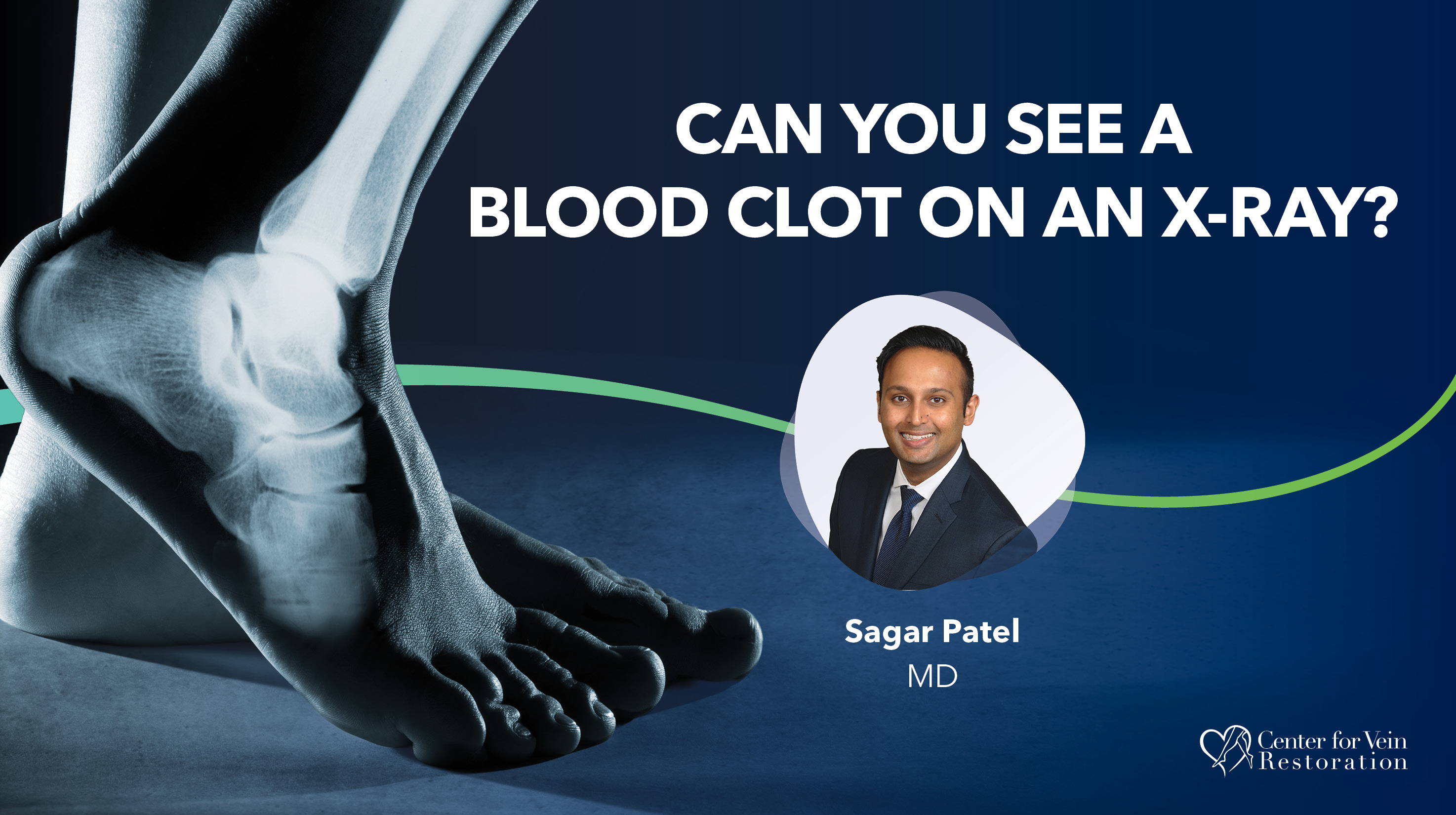 Blog Can You See A Blood Clot On An X Ray