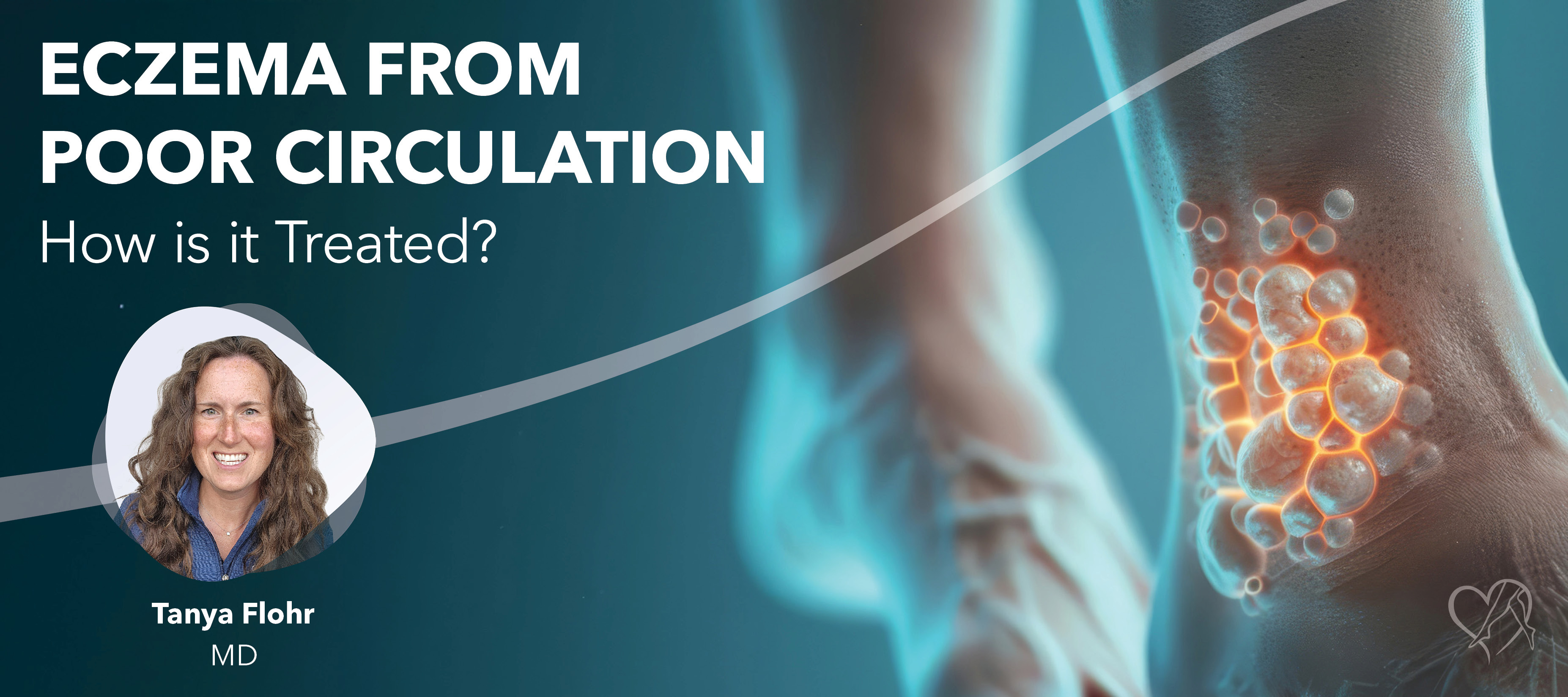 Eczema From Poor Circulation: How is it Treated?