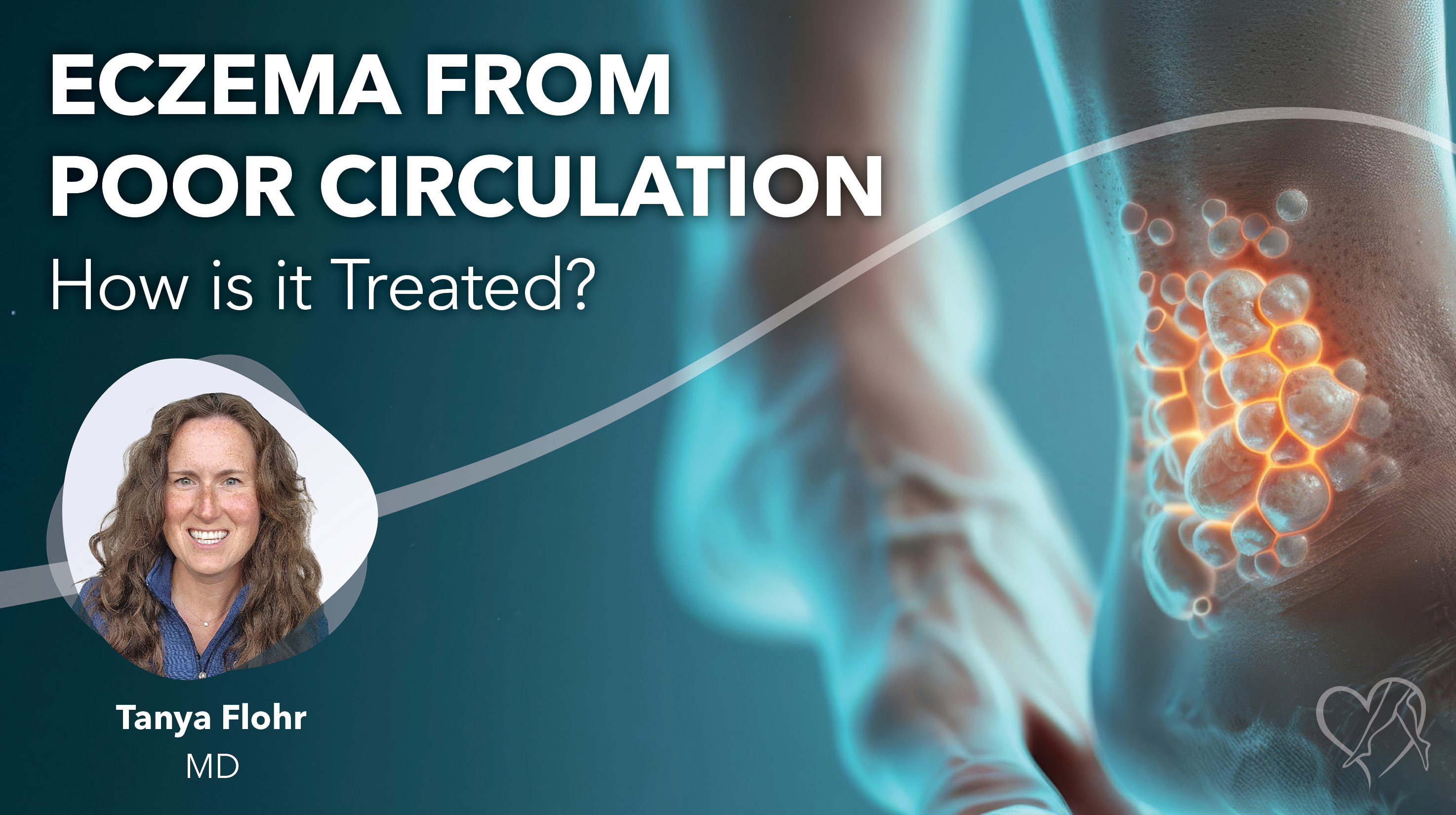 Blog Eczema From Poor Circulation Thumbnail