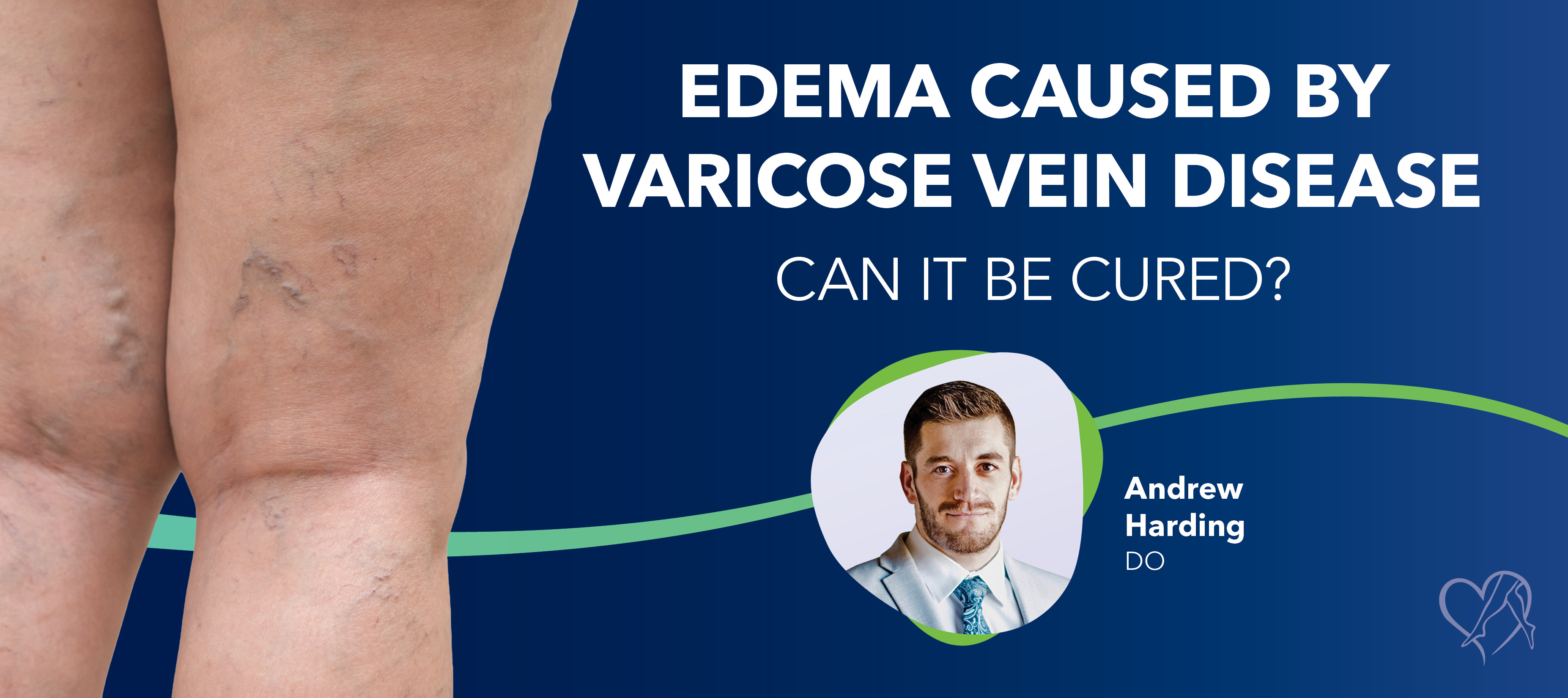 Blog Edema Caused By Varicose Vein Disease