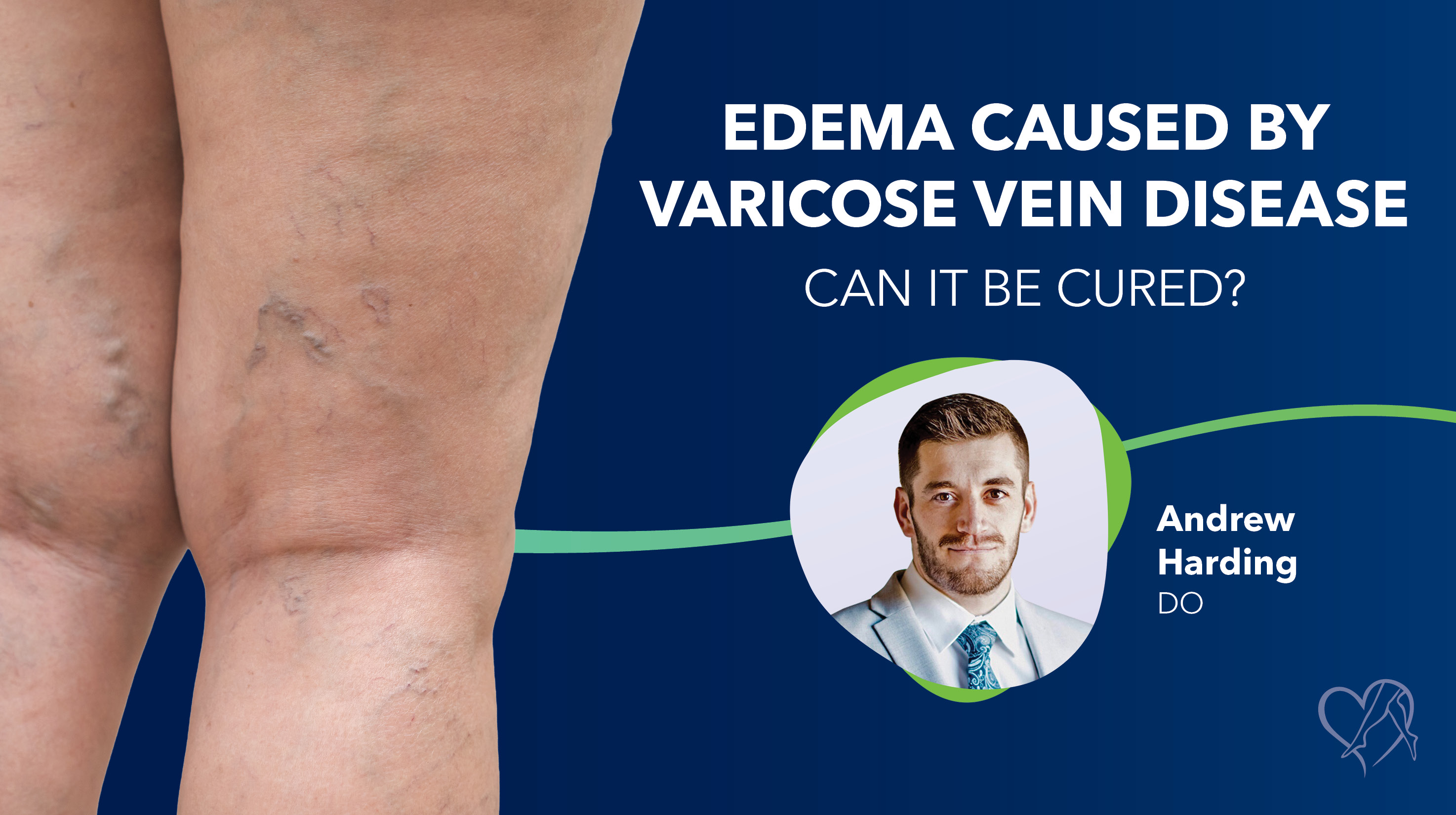 Blog Edema Caused By Varicose Vein Disease Thumbnail