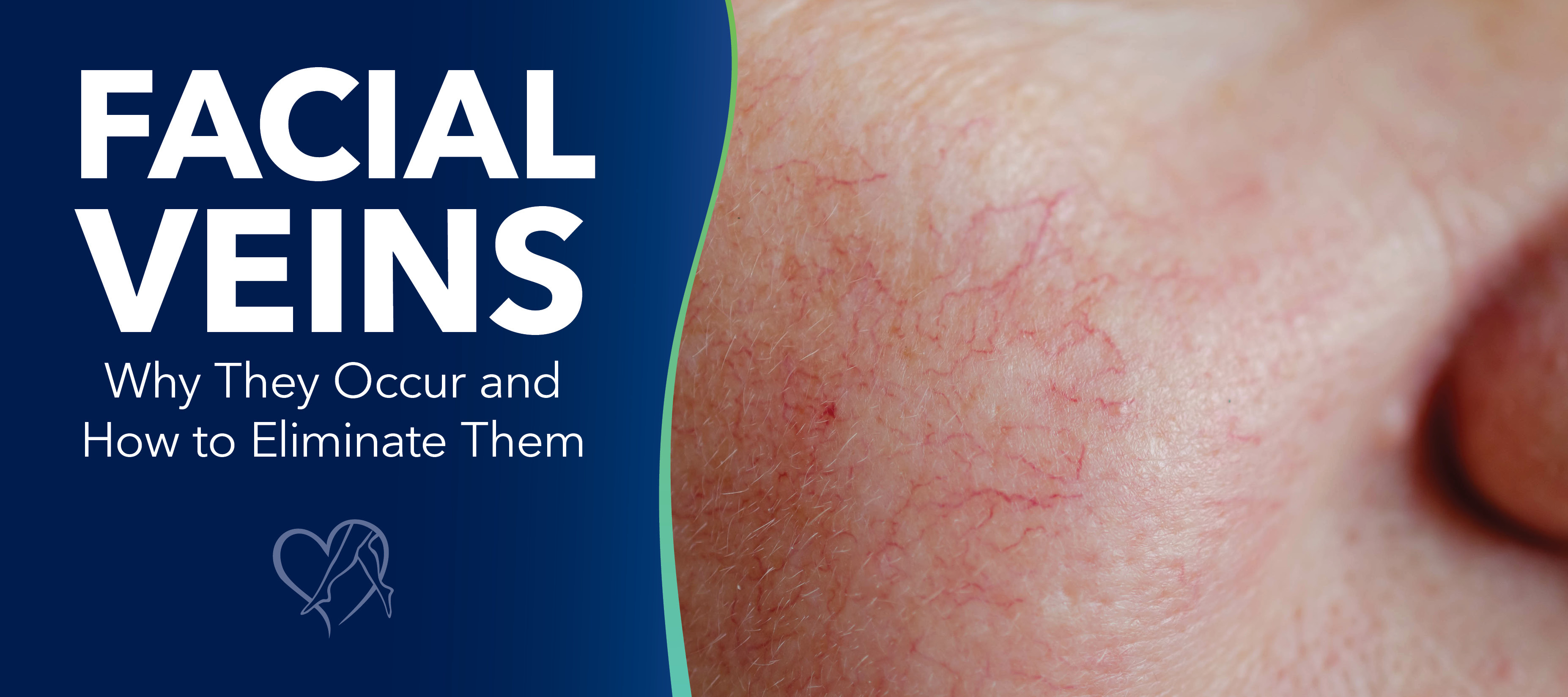 Blog Facial Veins
