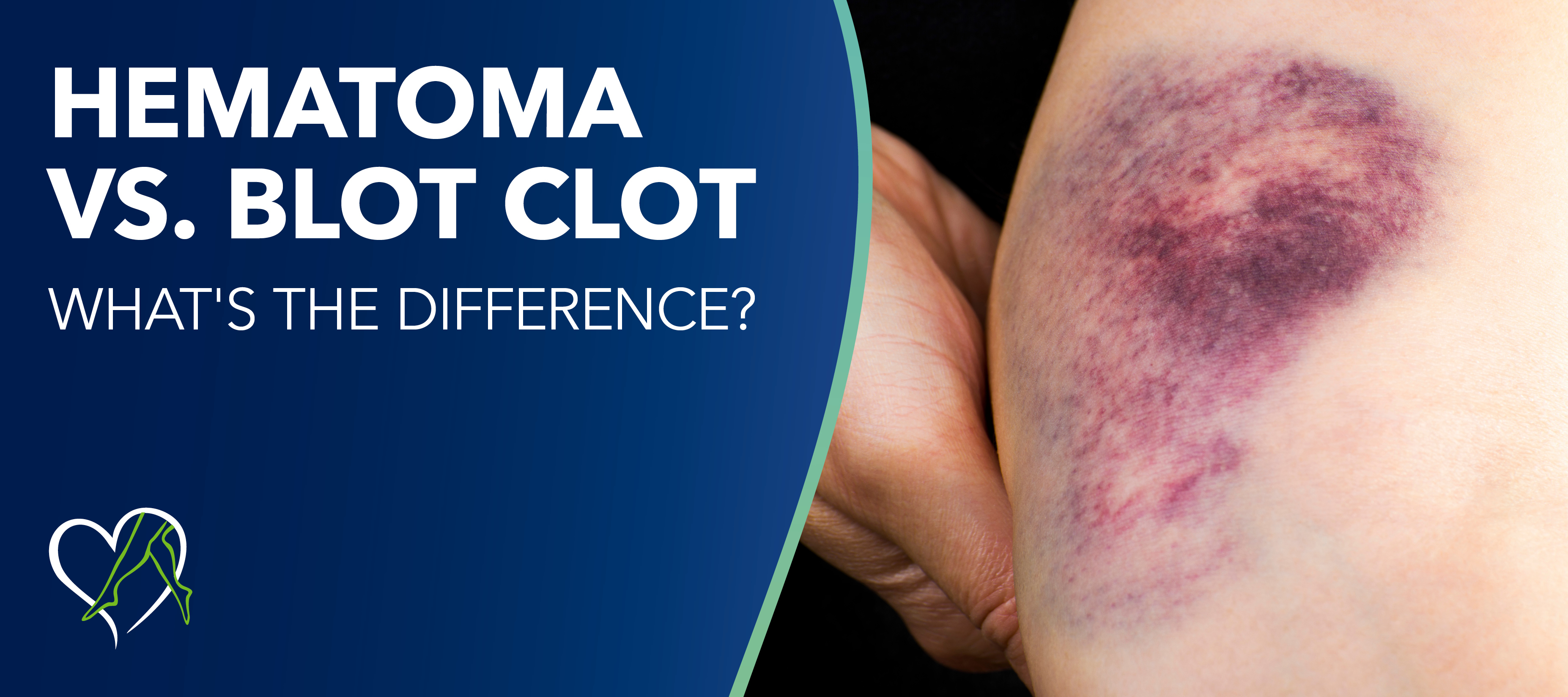 Blog Hematoma Vs Blood Clot