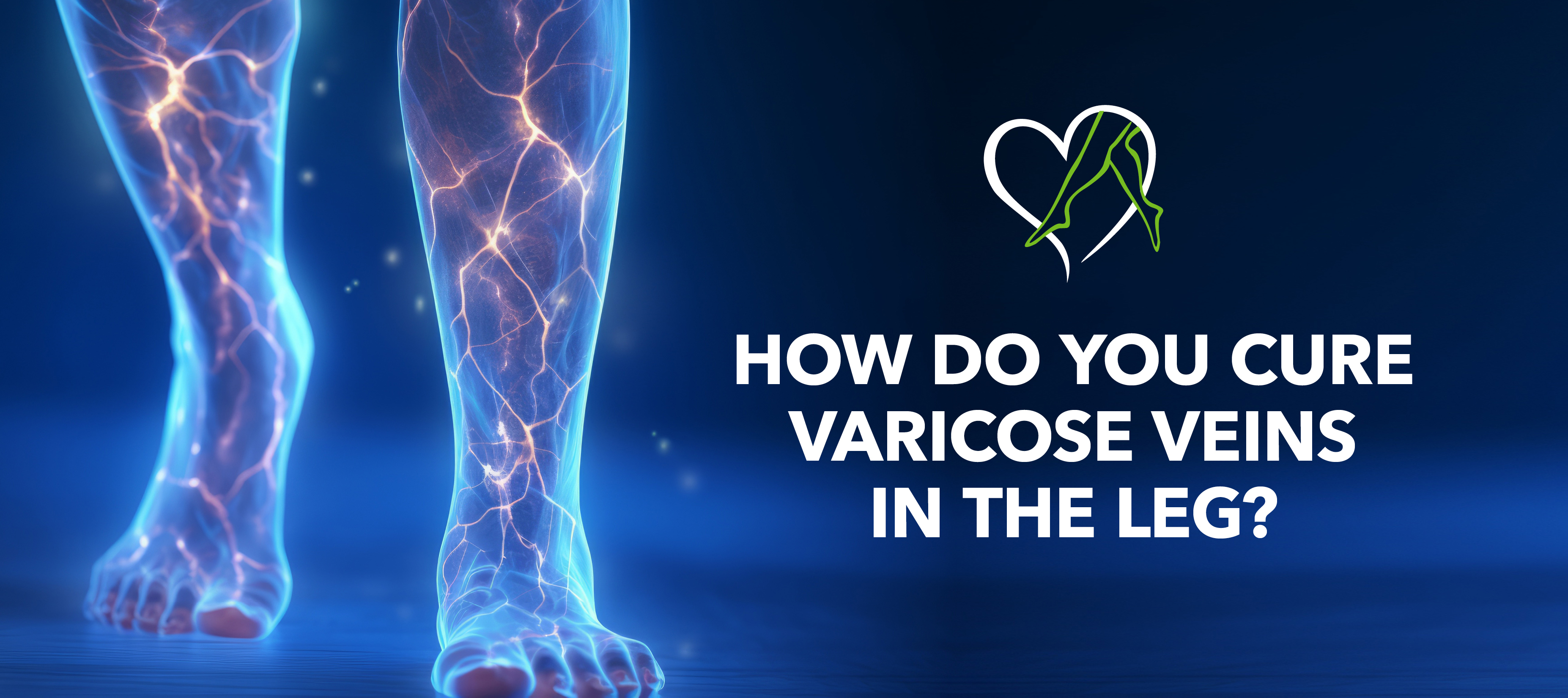 Blog How Do You Cure Varicose Veins
