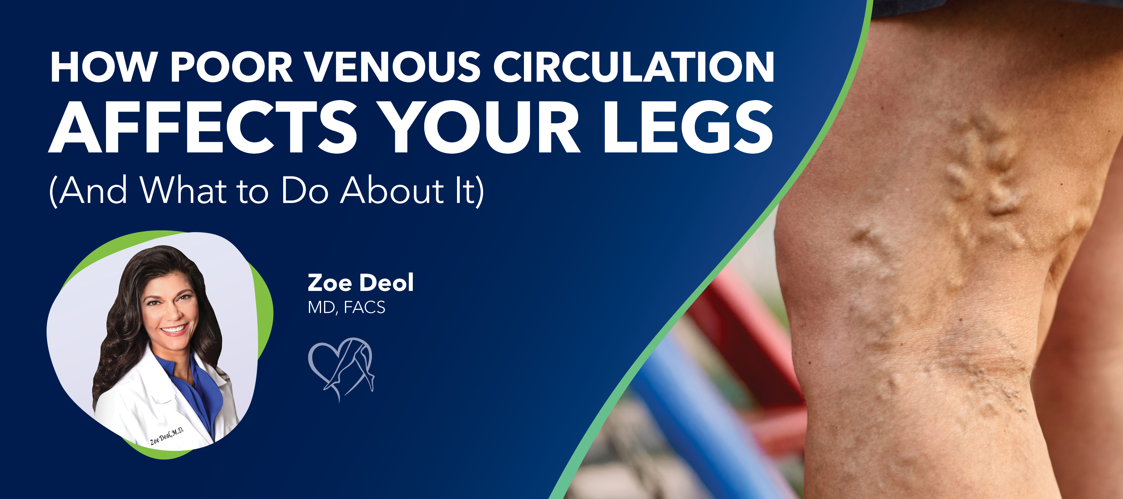 Blog How Poor Venous Circulation Affects Your Legs 2