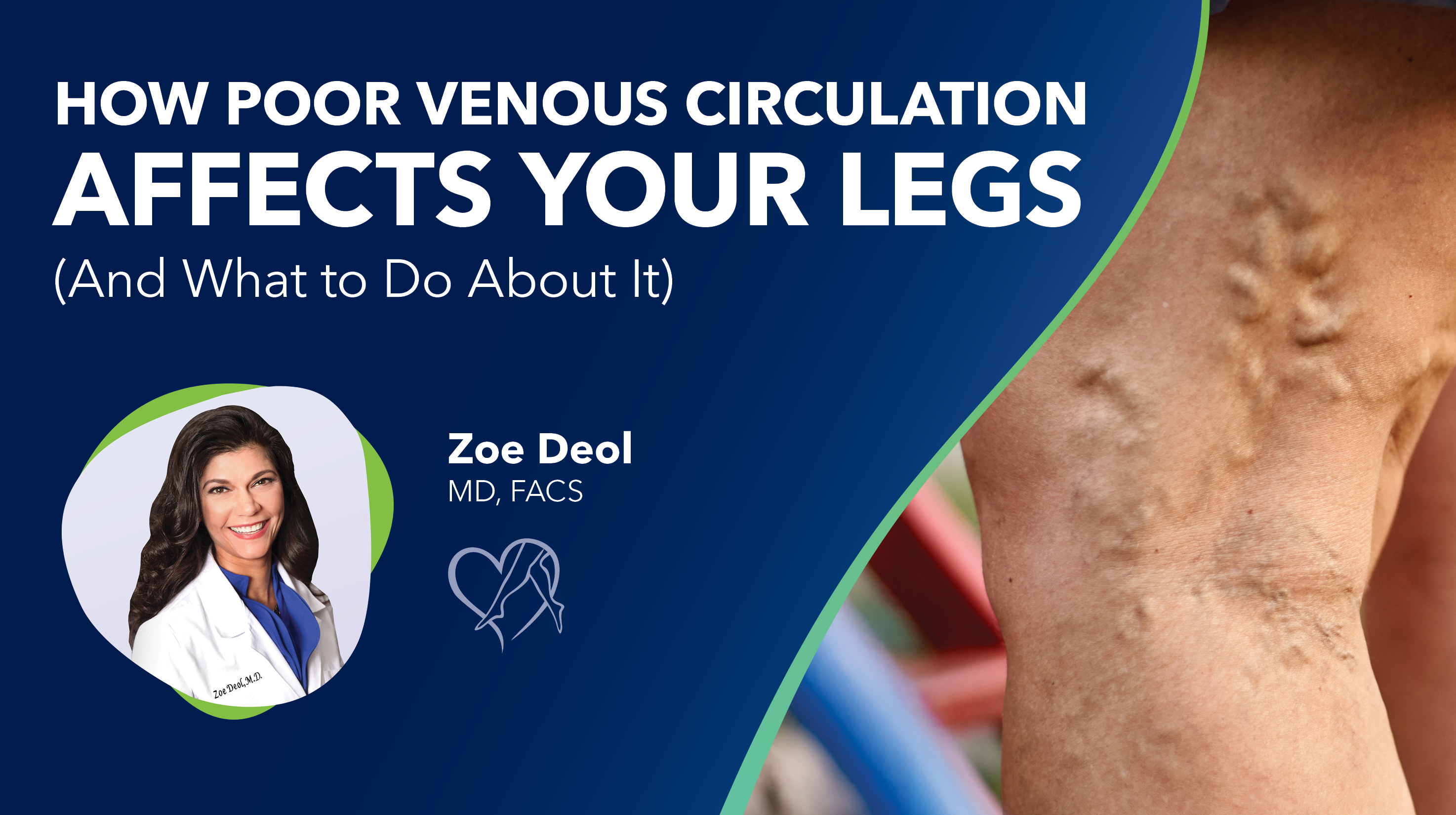 Blog How Poor Venous Circulation Affects Your Legs Thumbnail 2