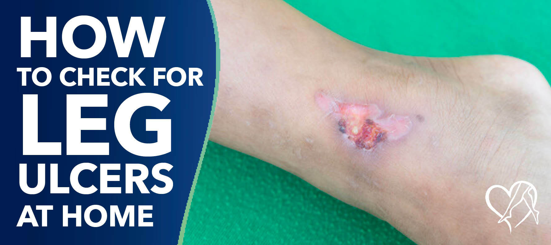 Blog How To Check For Leg Ulcers At Home