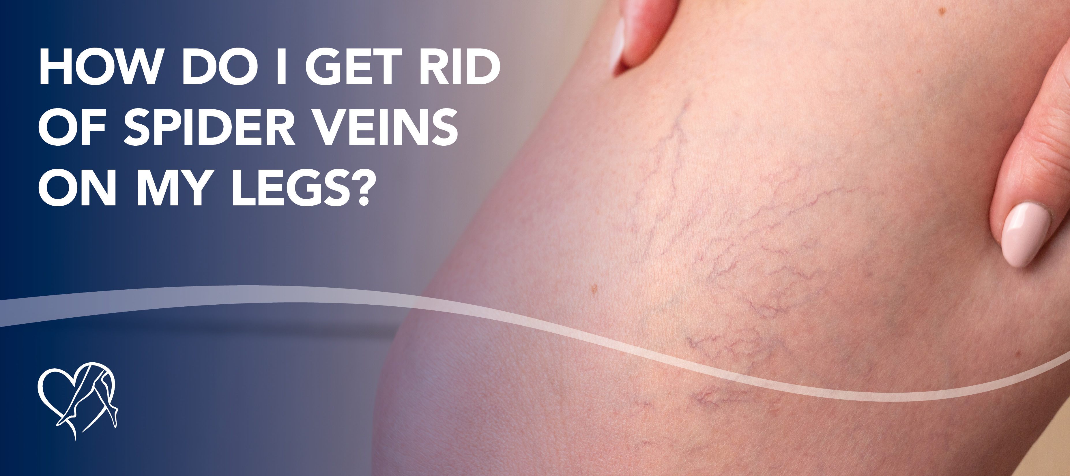 Blog Howdo I Get Rid Of Spider Veins On My Legs