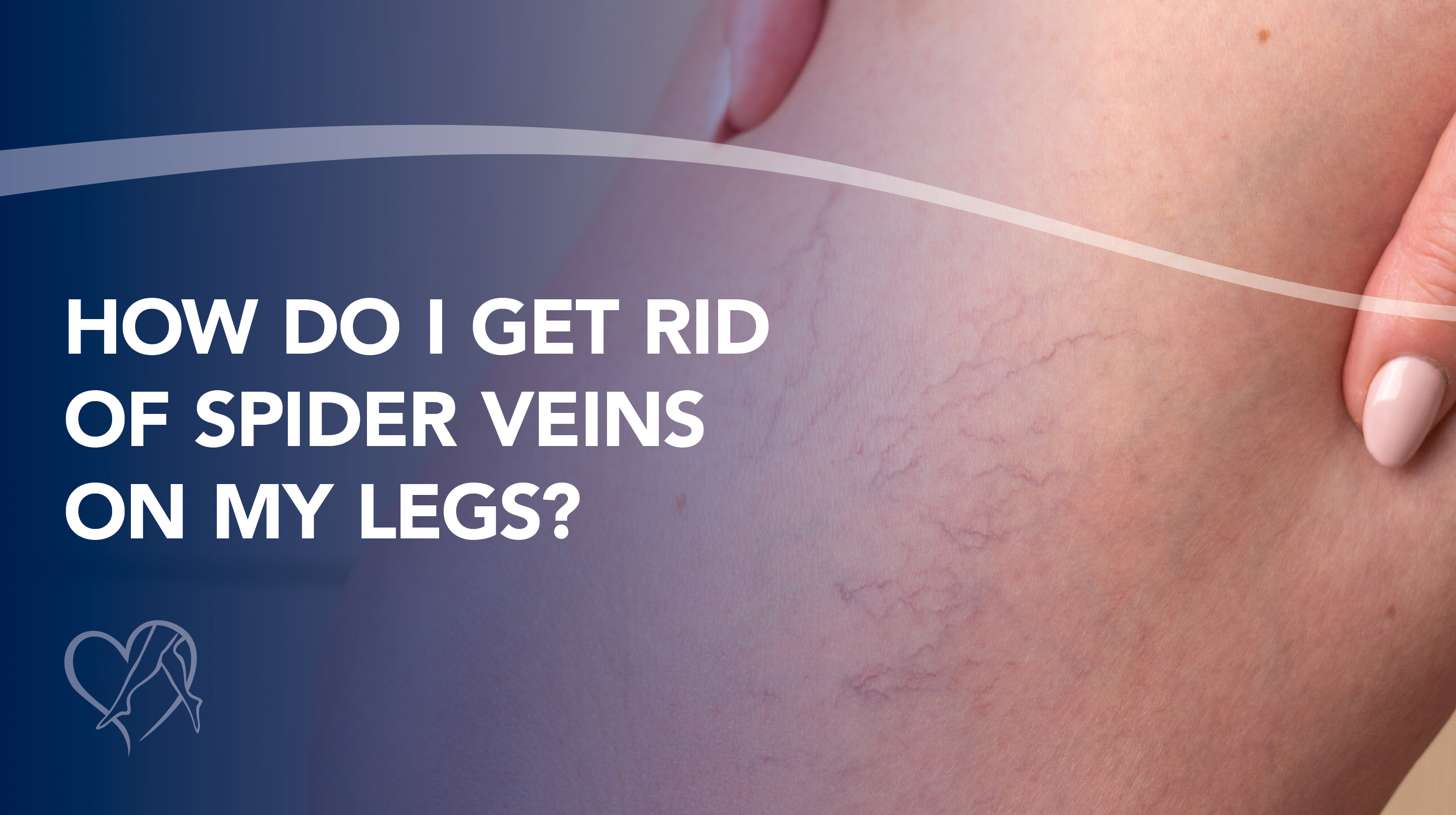Blog Howdo I Get Rid Of Spider Veins On My Legs Thumbnail