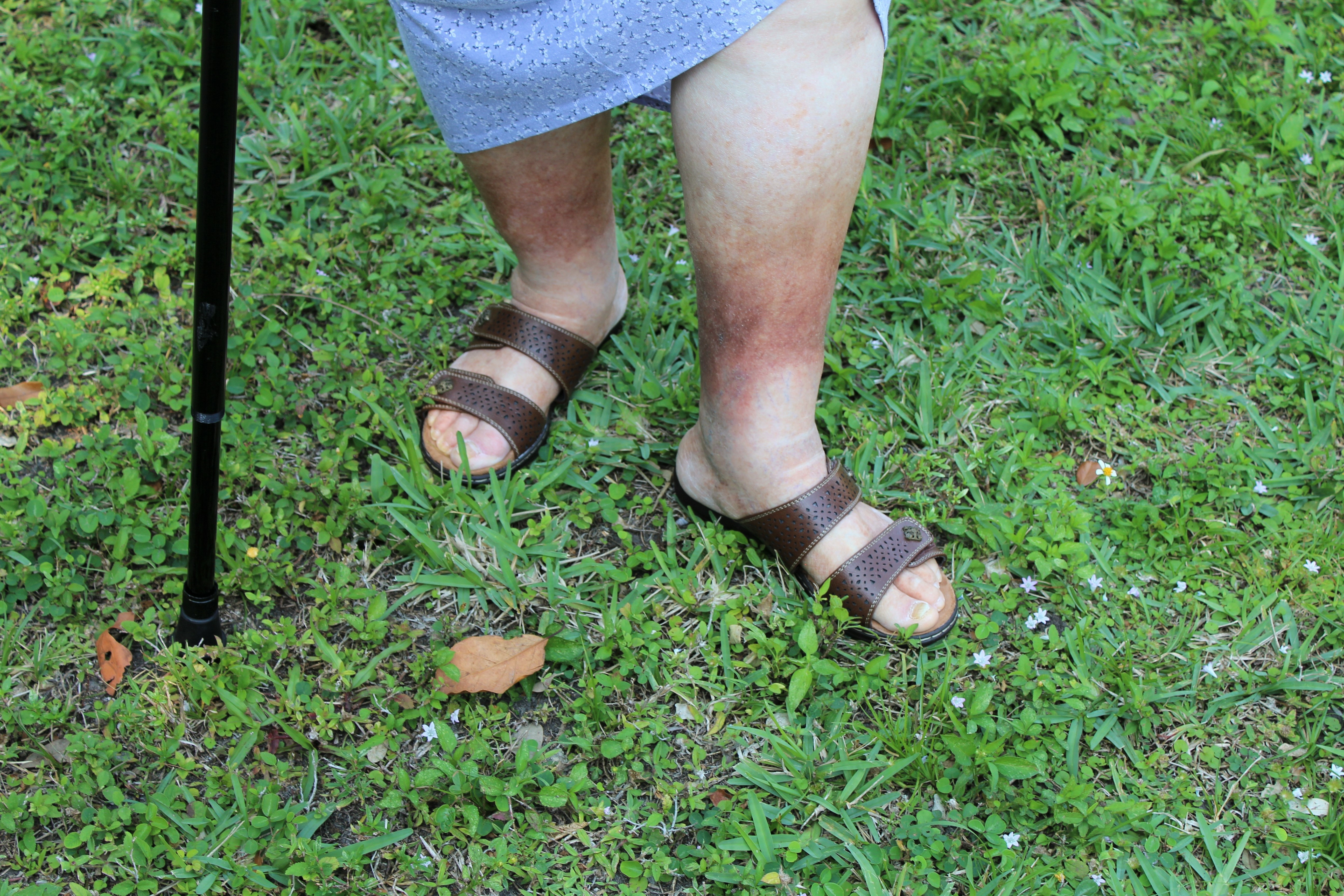 Blog Image VV Disability