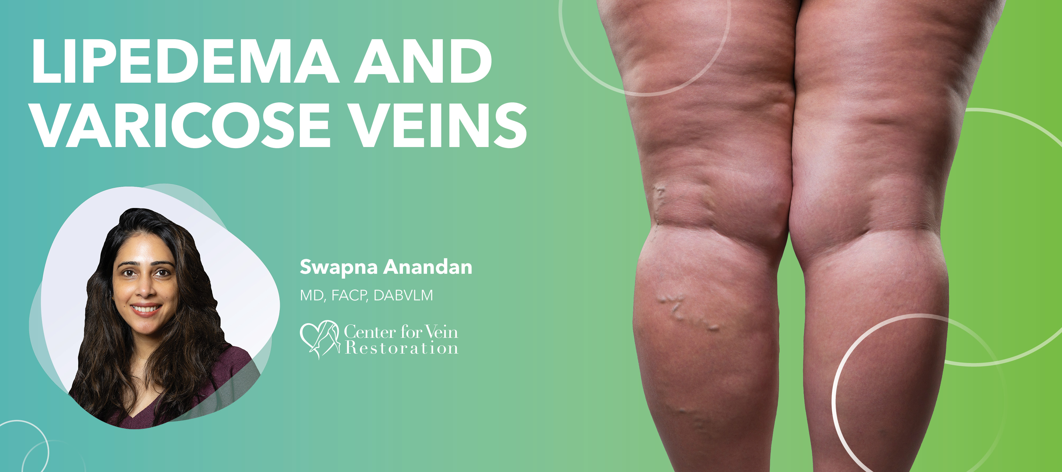 Blog Lipedema And Varicose Veins