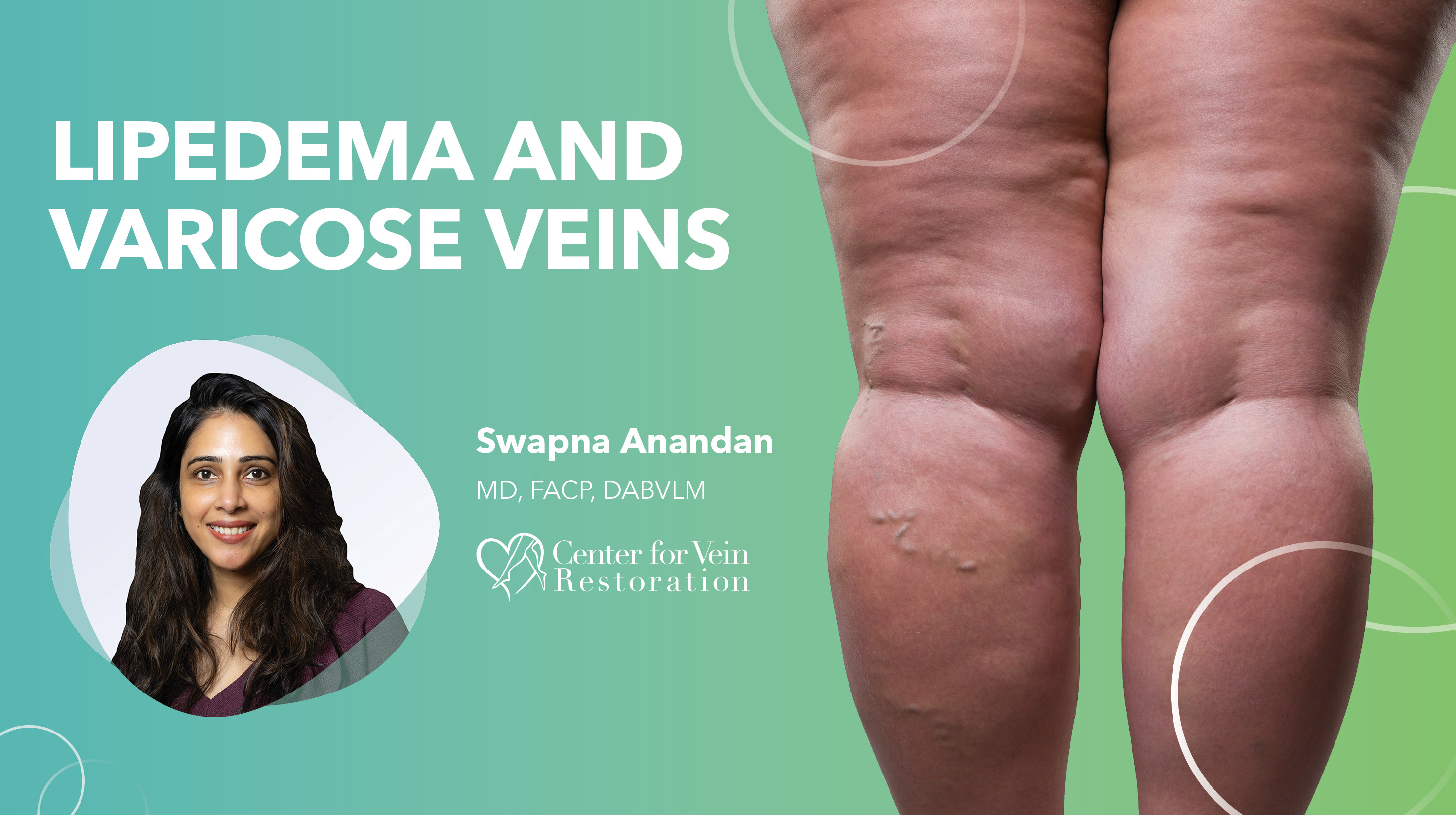 Blog Lipedema And Varicose Veins Thumbnail