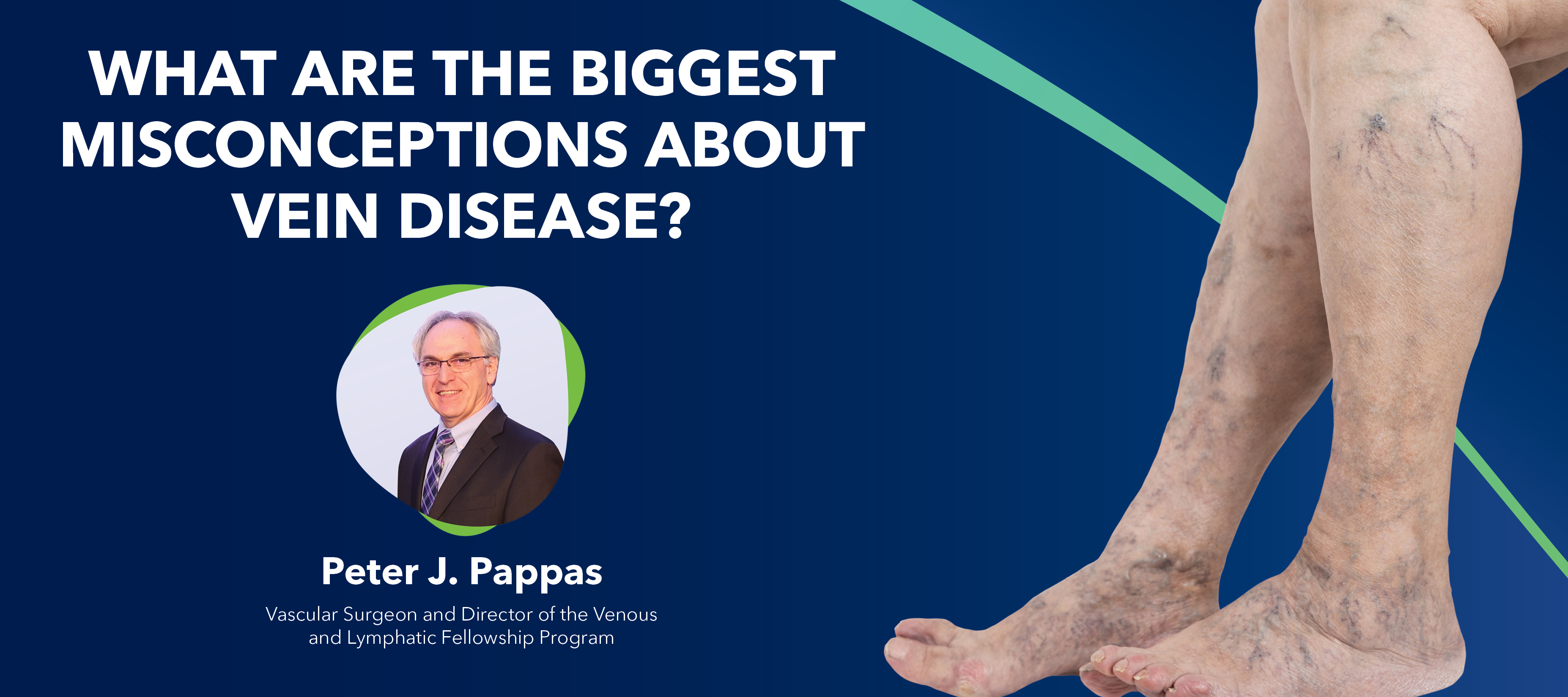 Blog Misconceptions About Vein Disease