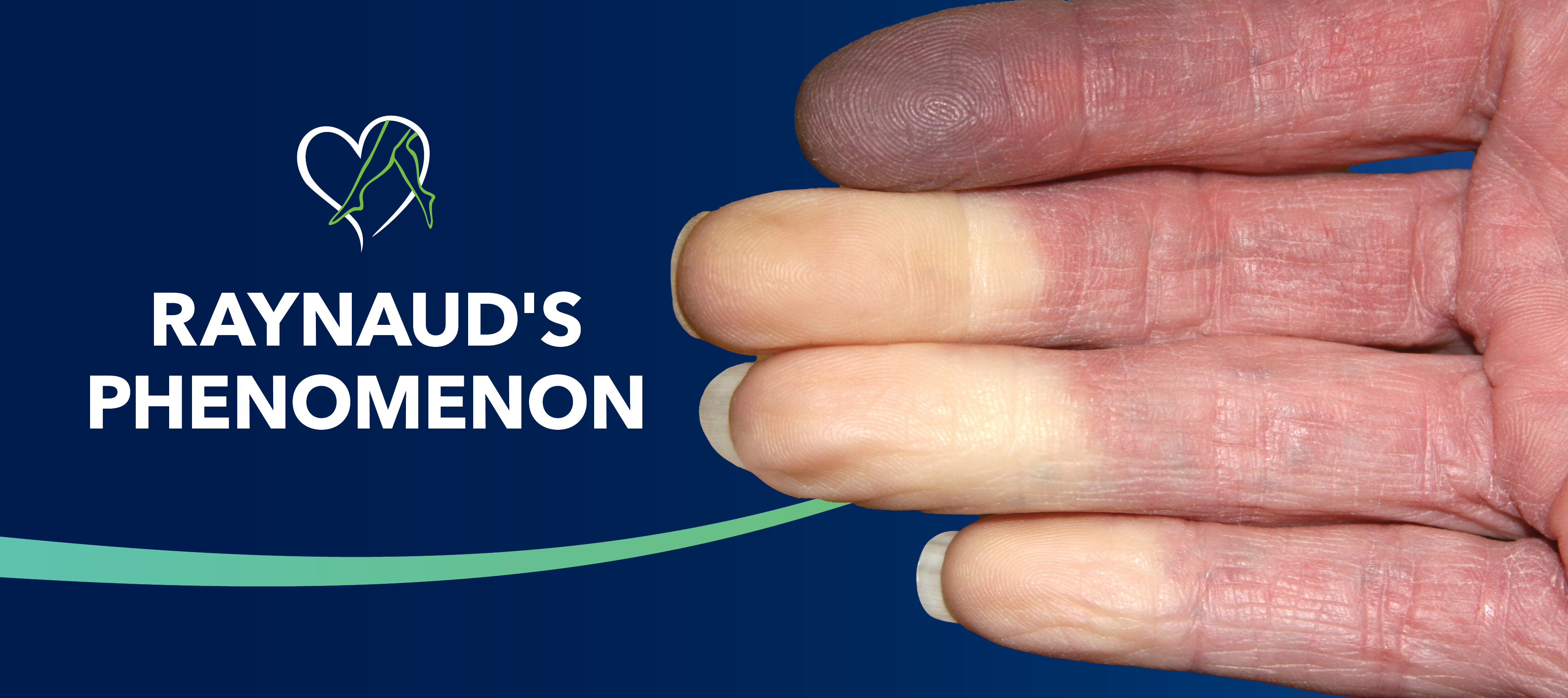 Blog Raynauds Phenomenon