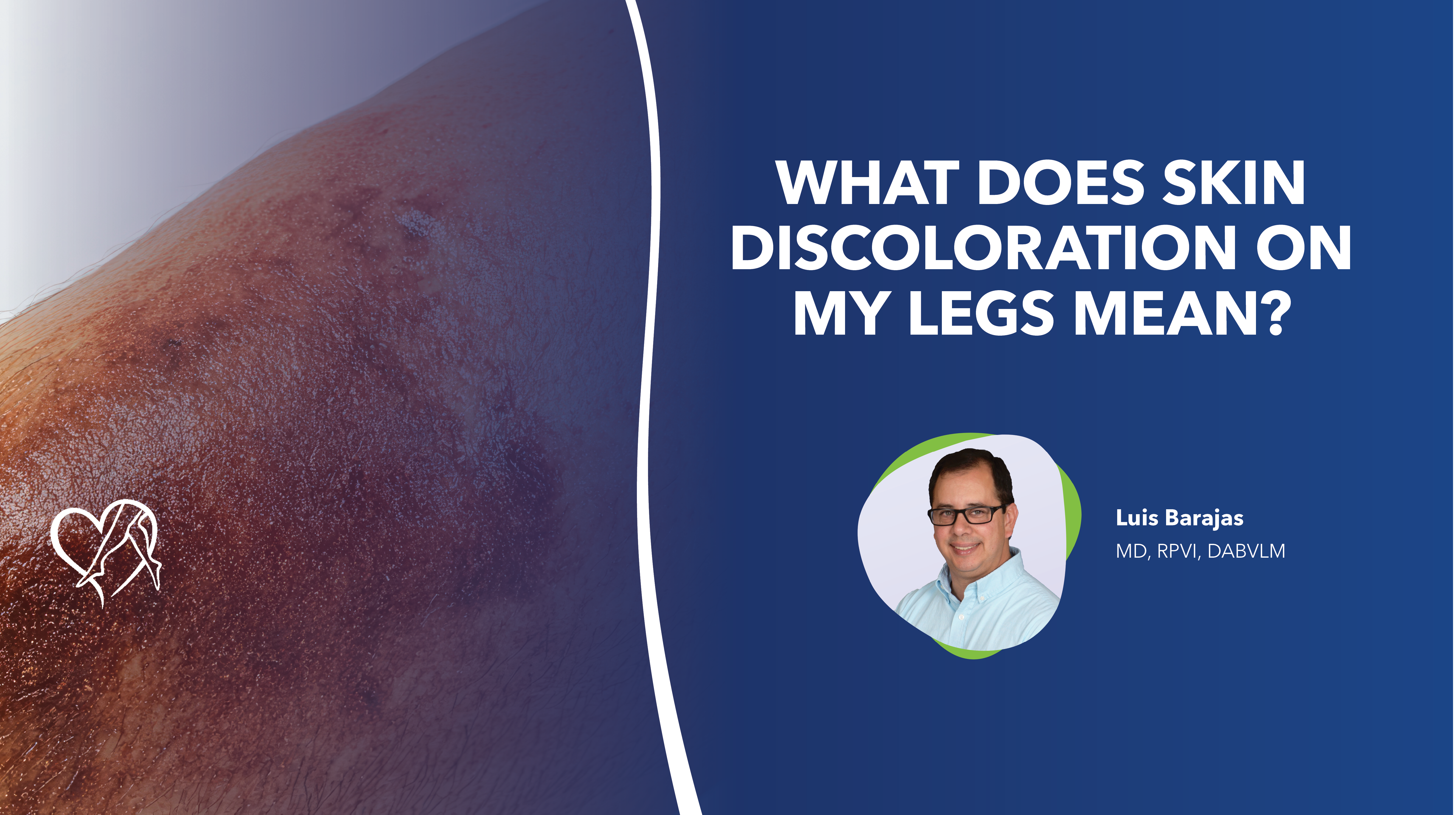 Blog Skin Discoloration Mean thumbnail