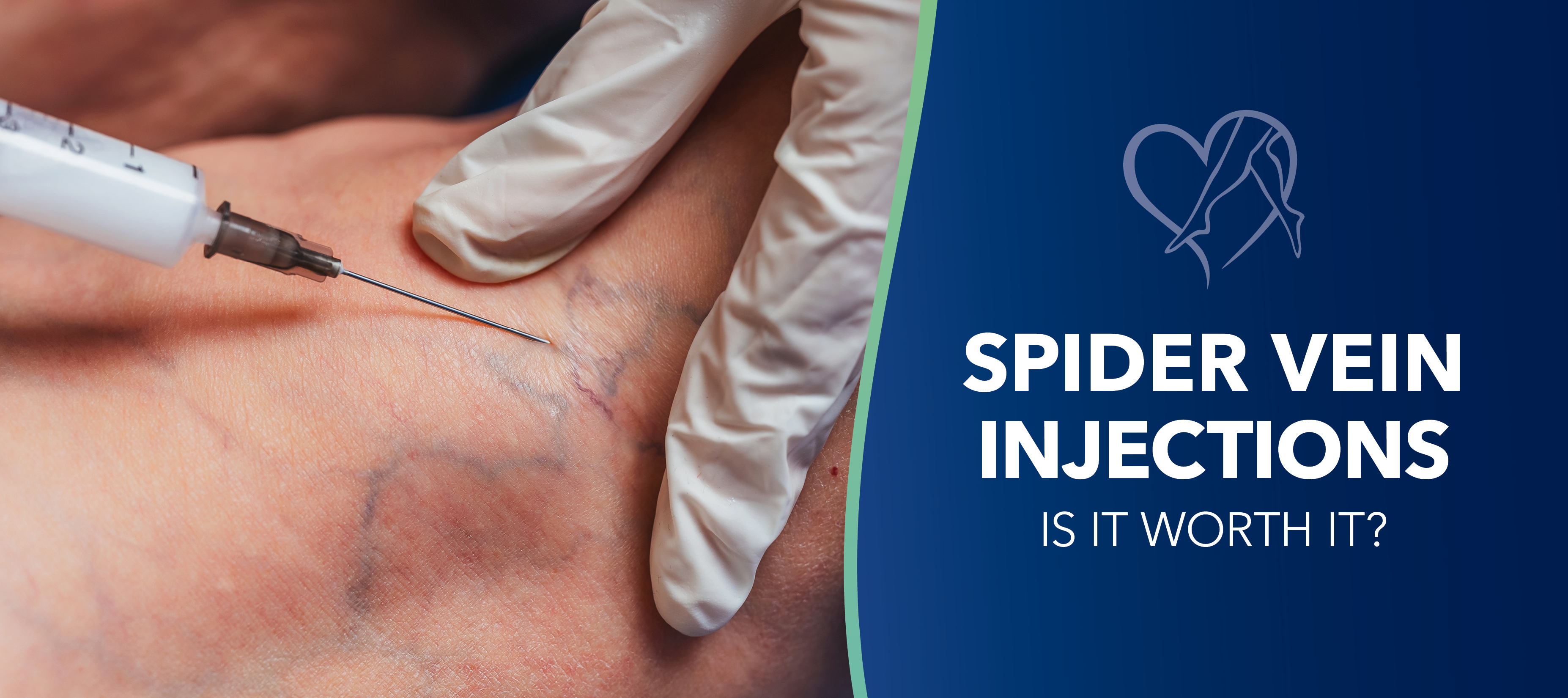 Spider Vein Injections: Is it Worth It?