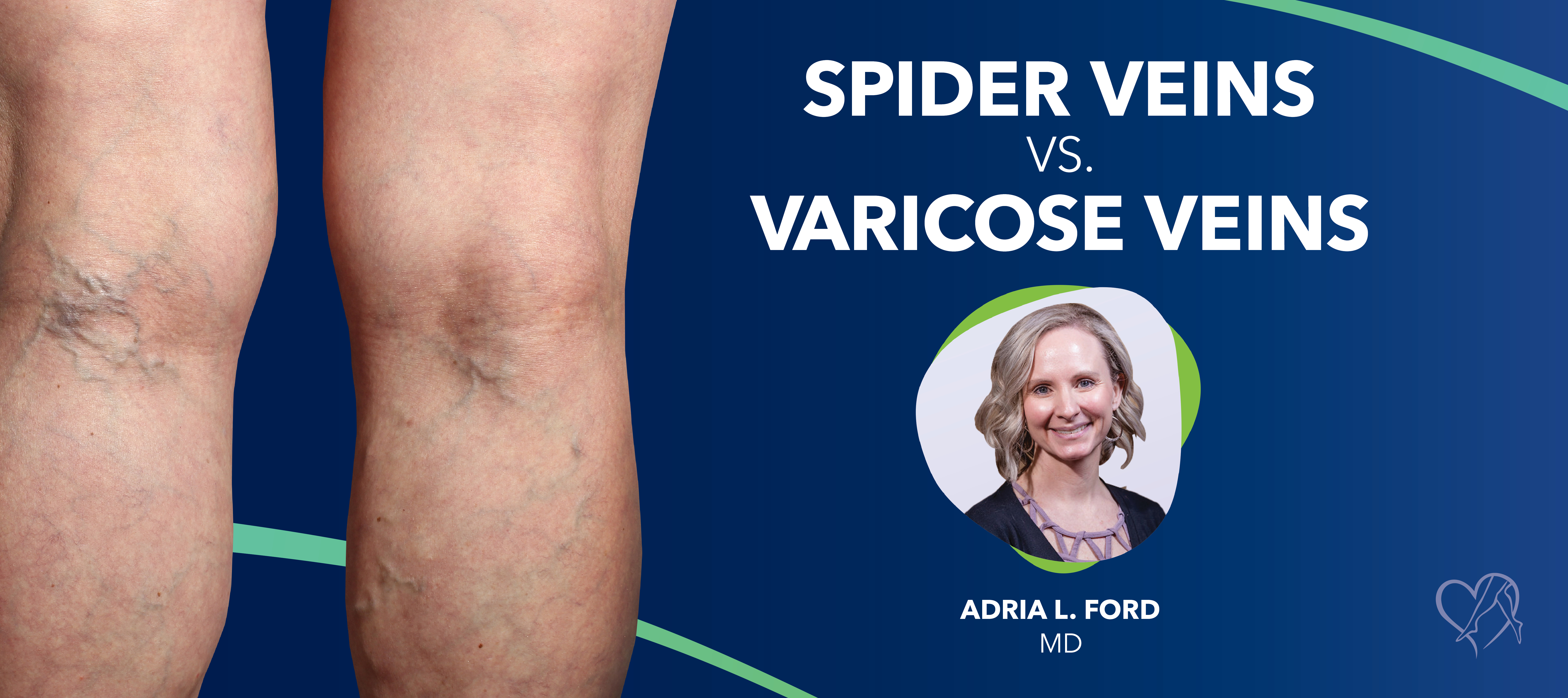 Blog Spider Veins VS Varicose Veins