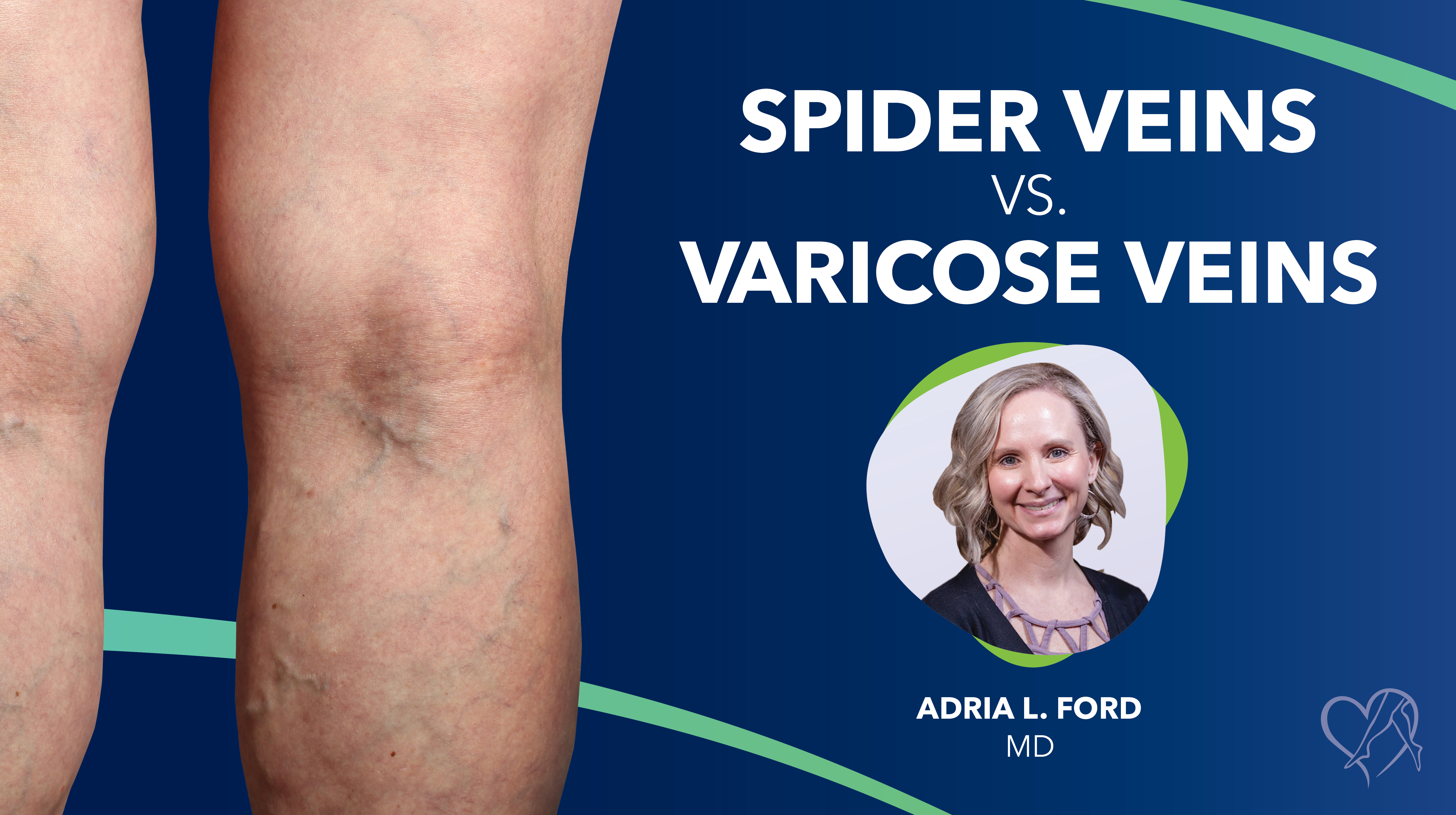 Blog Spider Veins VS Varicose Veins Thumbnail