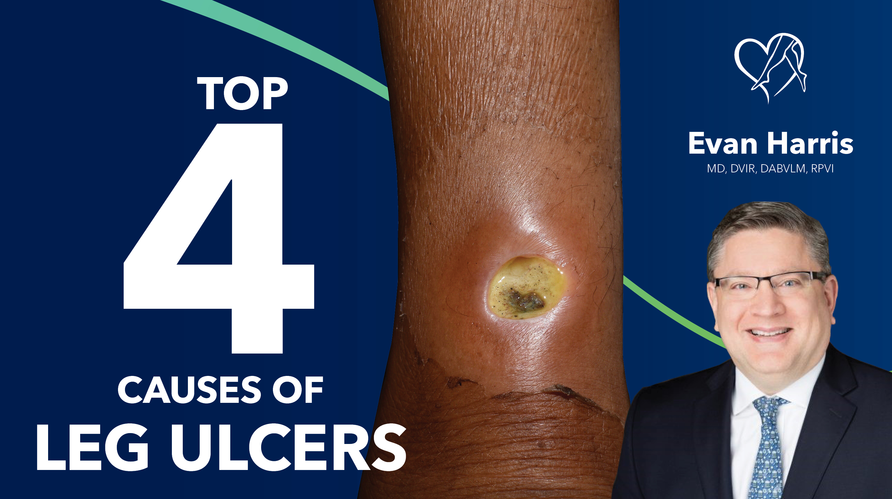 Blog Top4 Causes Of Leg Ulcers Thumbnail