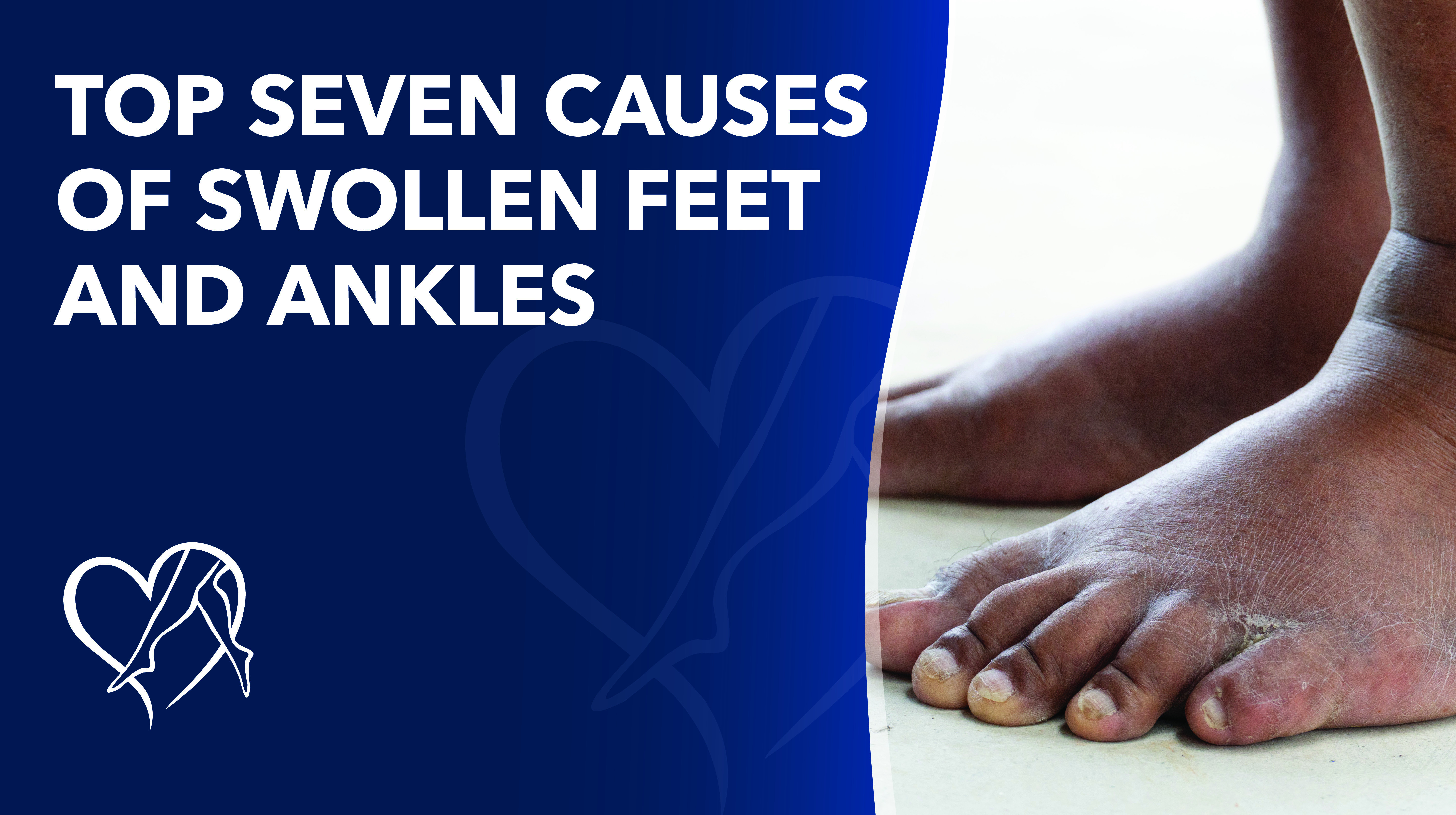 Blog Top Seven Causesof Swollen Feetand Ankles Thumbnail