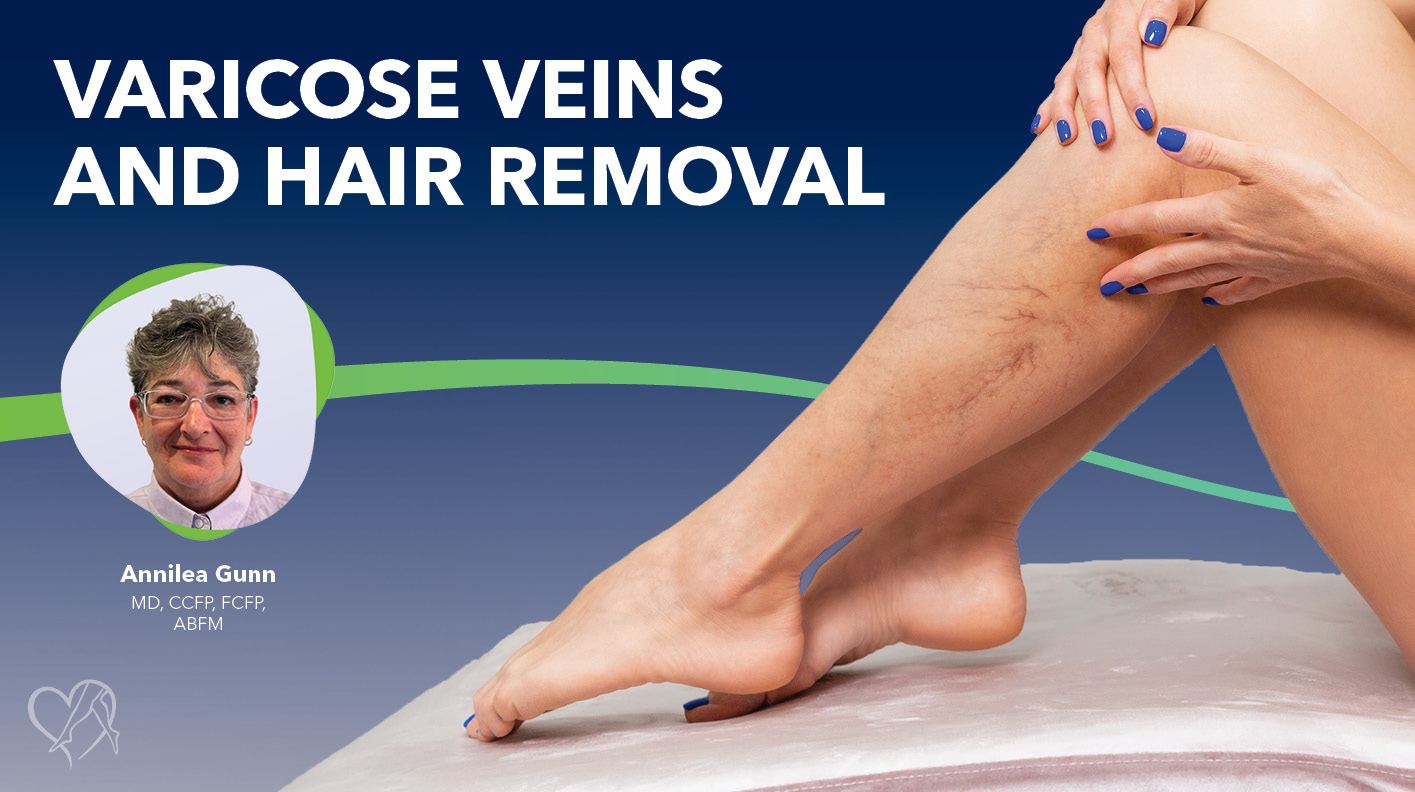 Blog Varicose Veins And Hair Removal Thunbnail