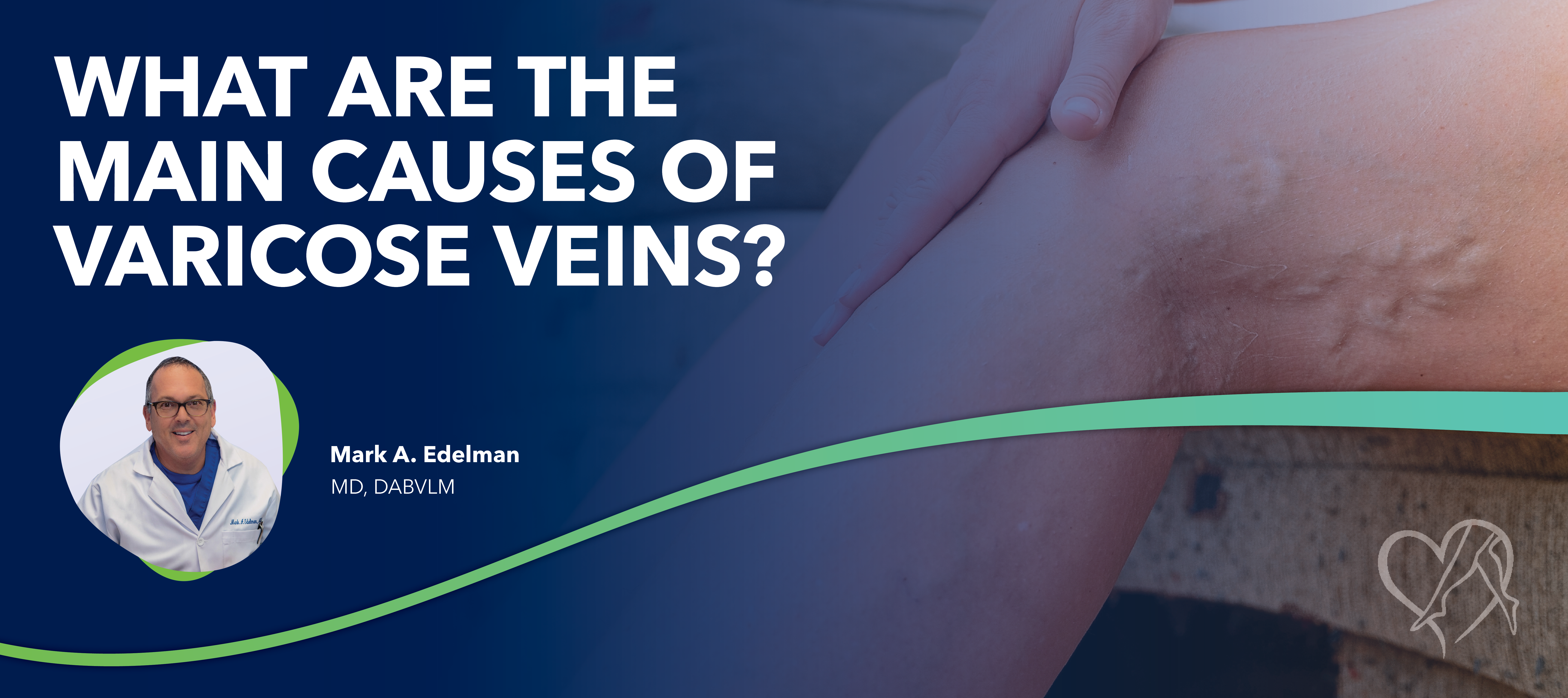 Blog What are the Main Causes of Varicose Veins