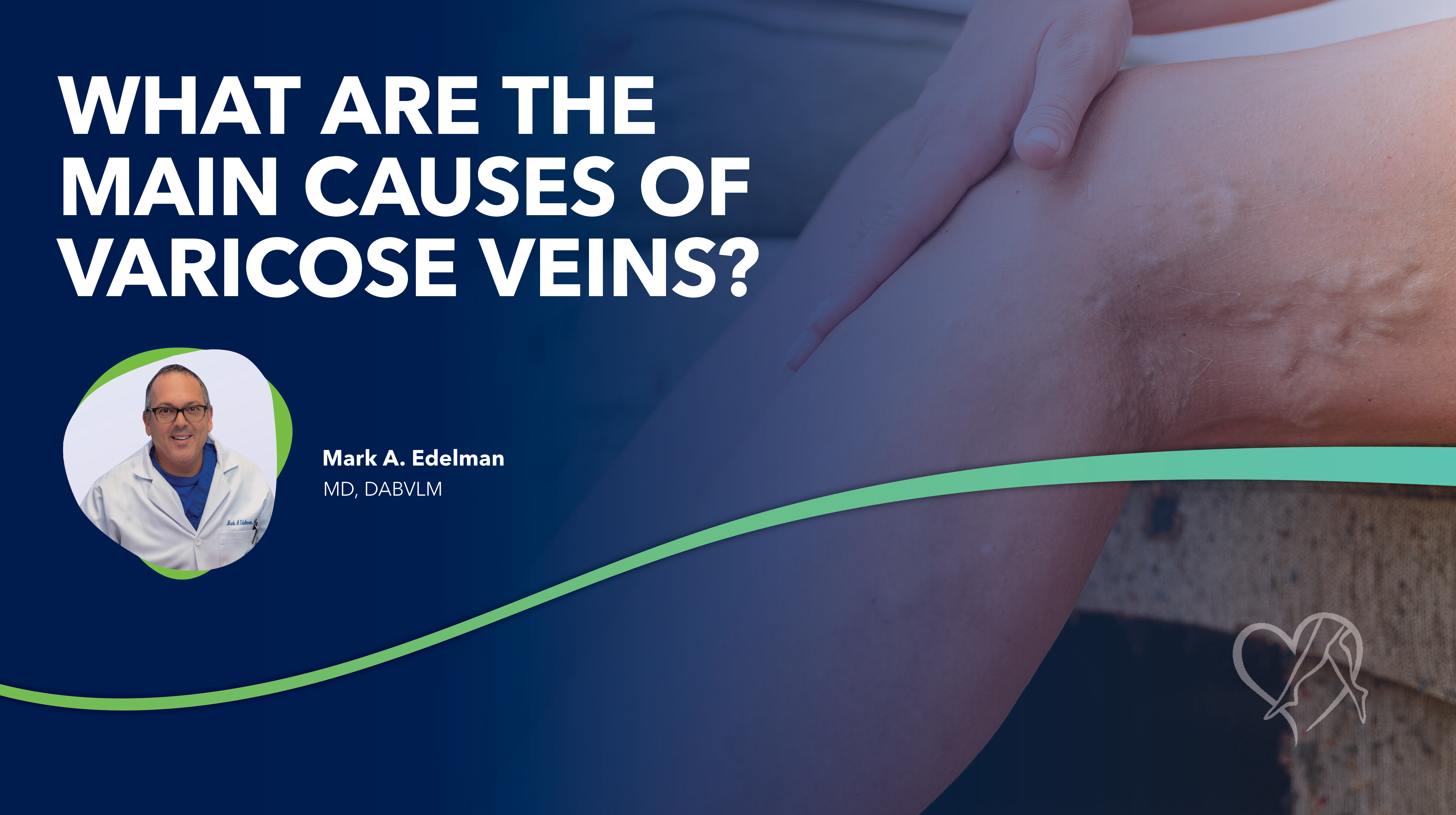 Blog What are the Main Causes of Varicose Veins thumbnail