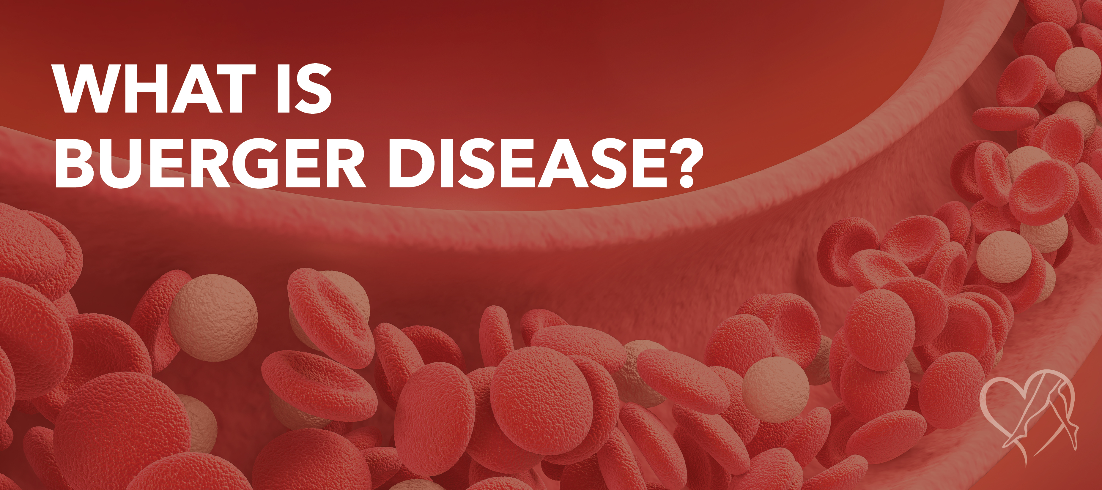 https://cdn.craft.cloud/4f7c8d17-0c96-40cd-89a4-3f6a0150b271/assets/images/Blog_What-is-BuergerDisease.jpg?width=360&quality=80&fit=contain&s=bKmTEjd2sA5WSebNdGRfmcbzm9-D--3evJ6NdALzJkA