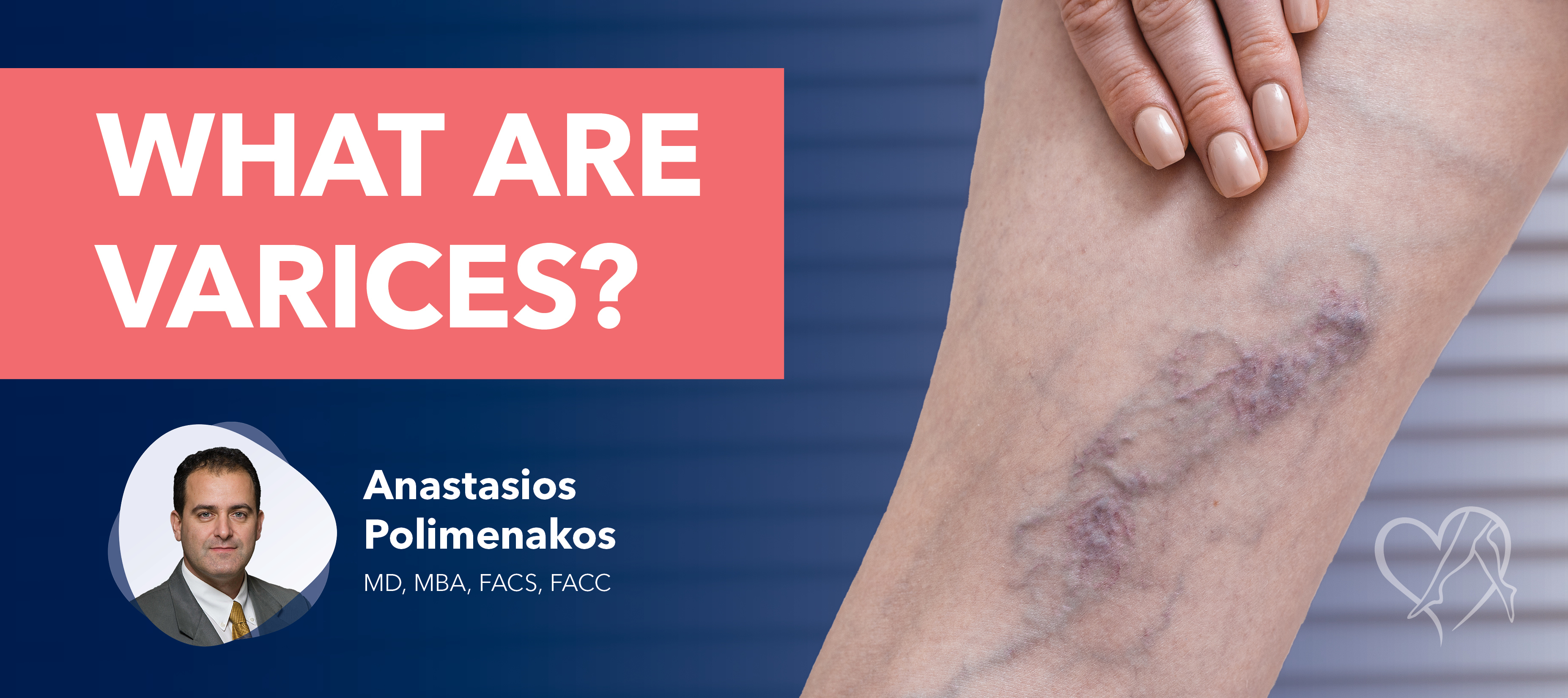 Blog What Are Varices Polimenakos