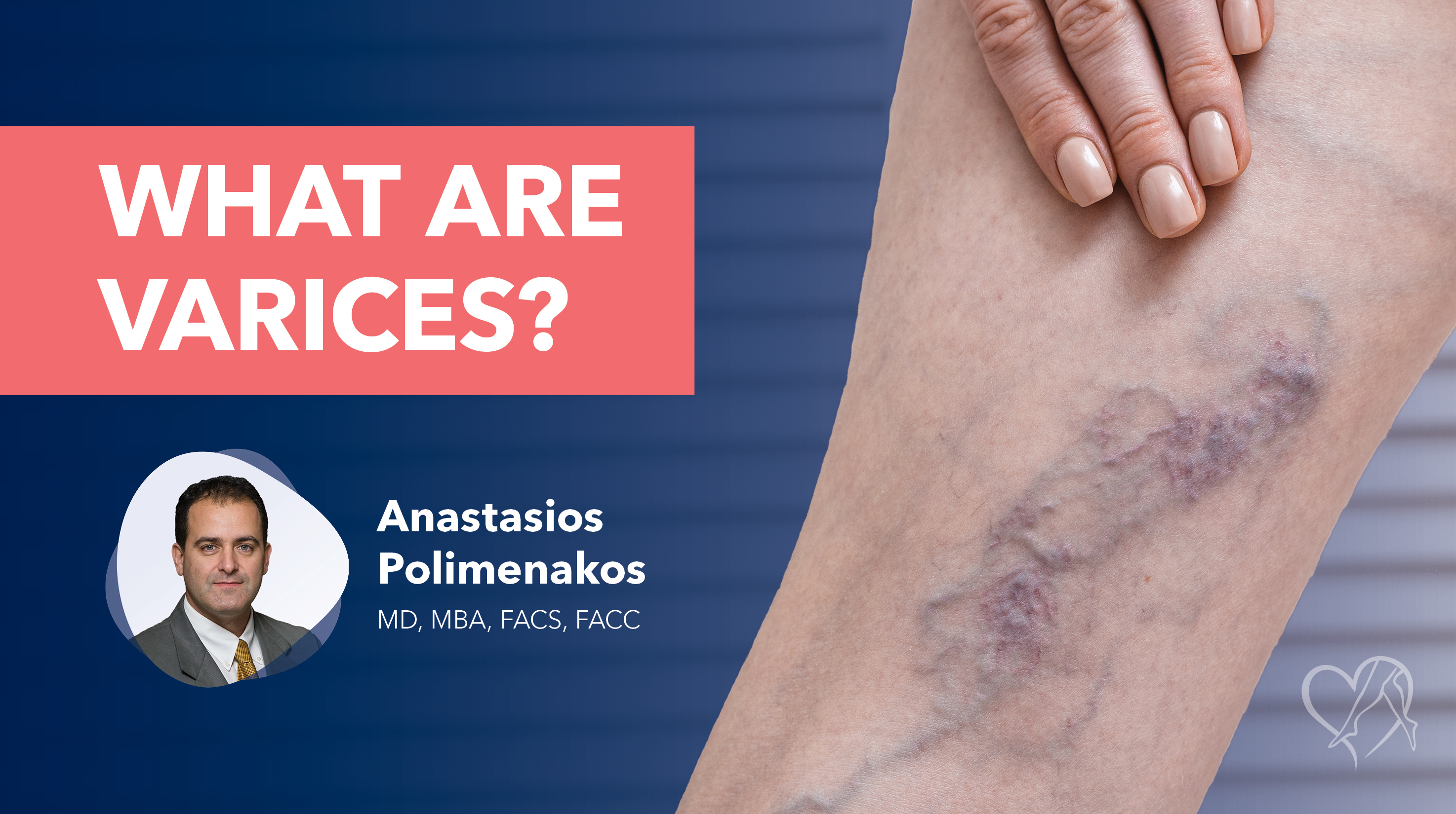 Blog What Are Varices Polimenakos Thumbnail