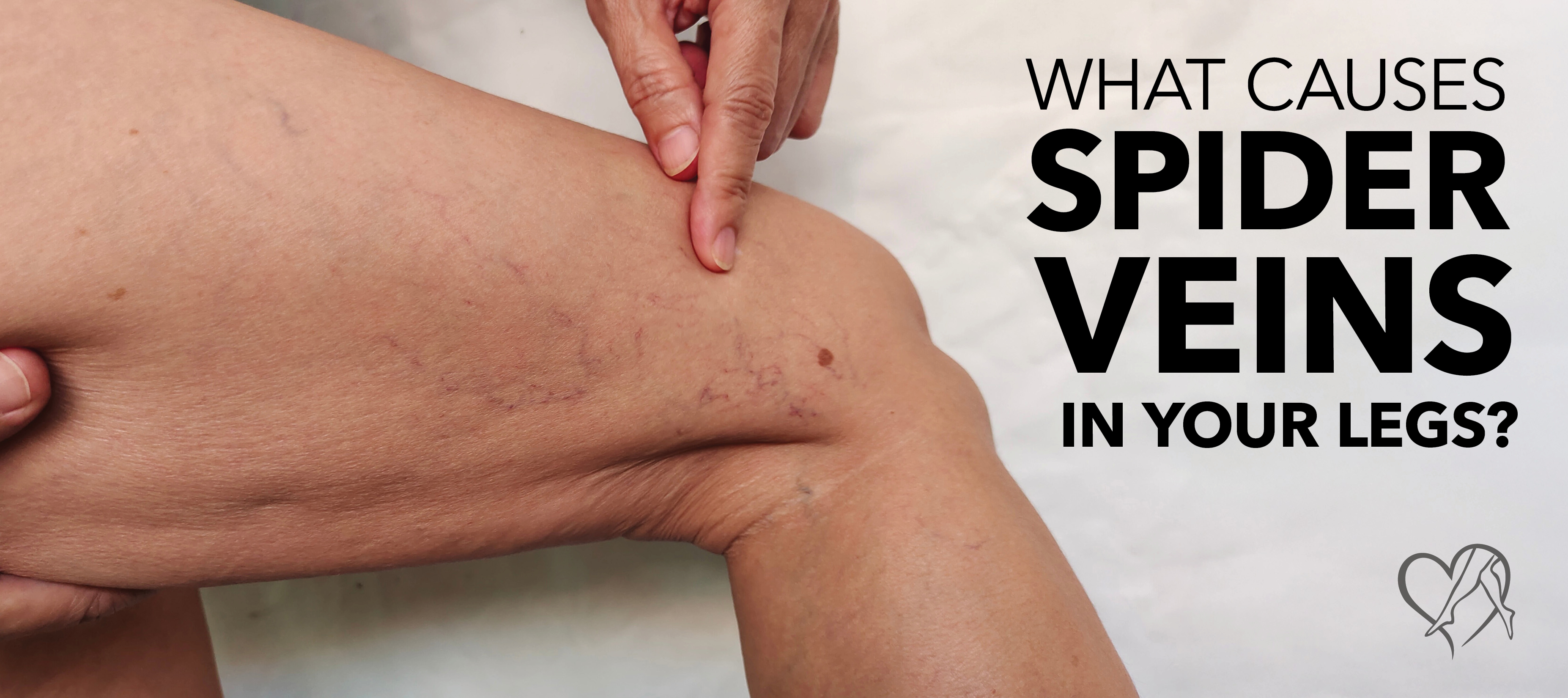 Blog What Causes Spider Veins In Your Legs