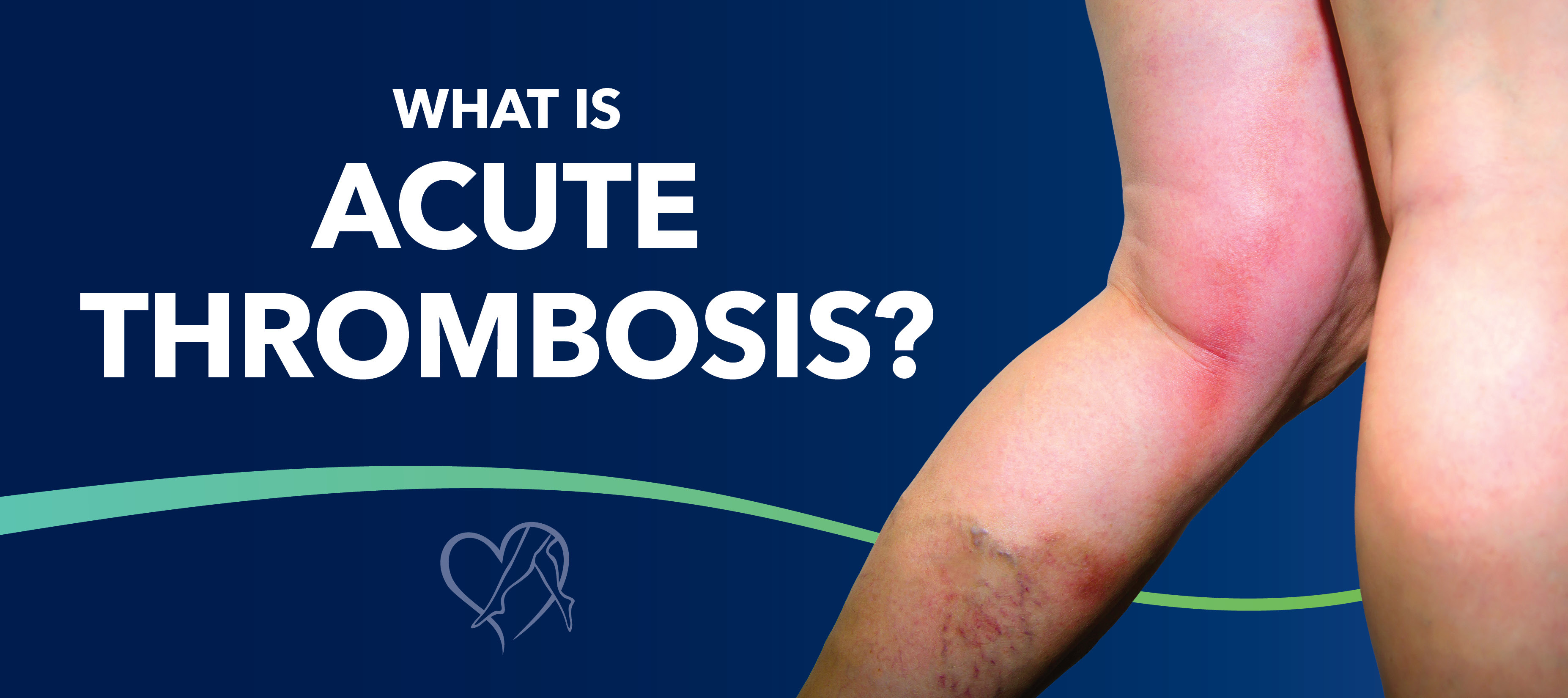 Blog What Is Acute Thrombosis
