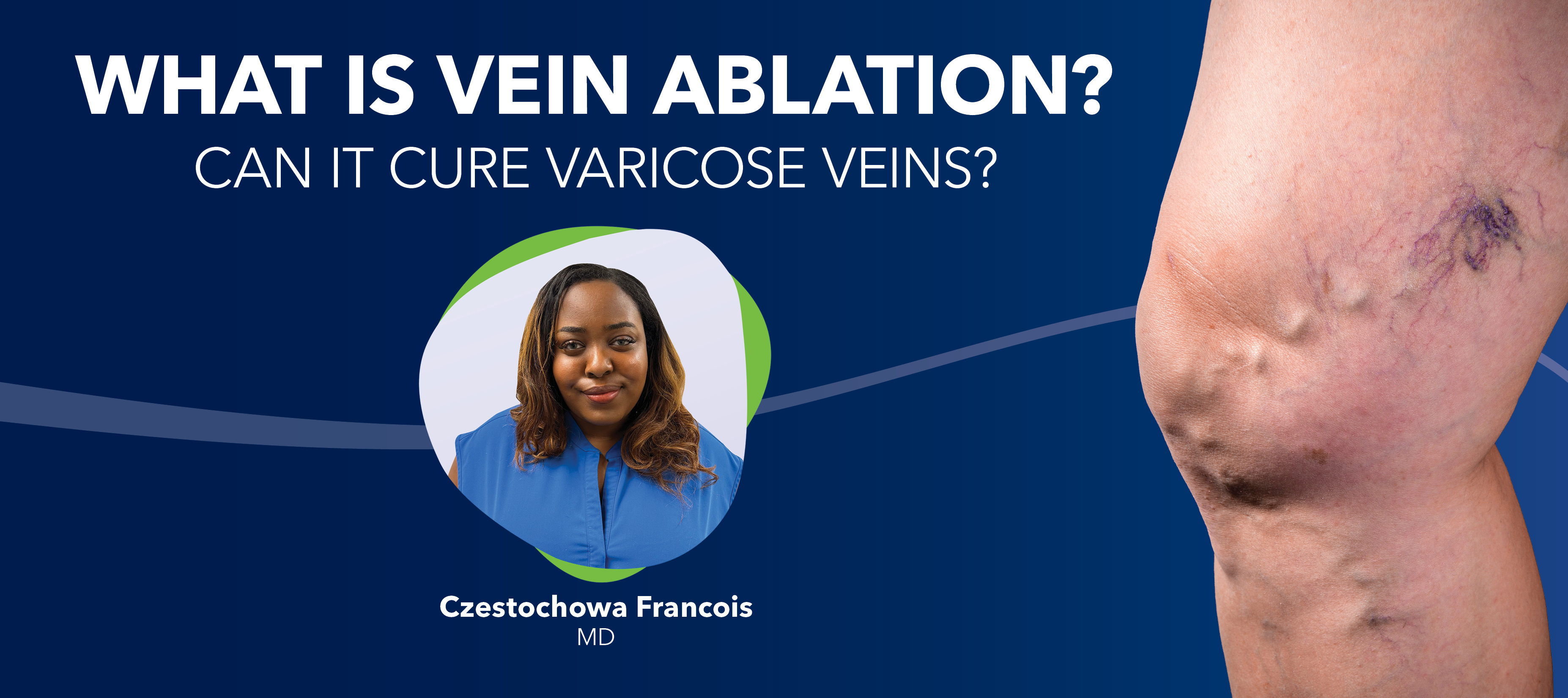 Blog What Is Vein Ablation 1