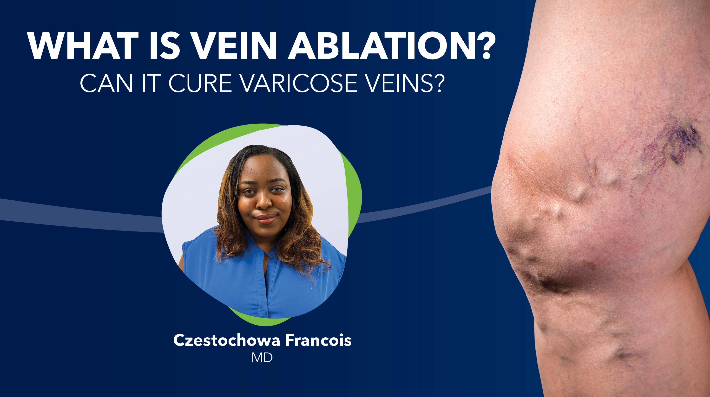 Blog What Is Vein Ablation Thumbnail